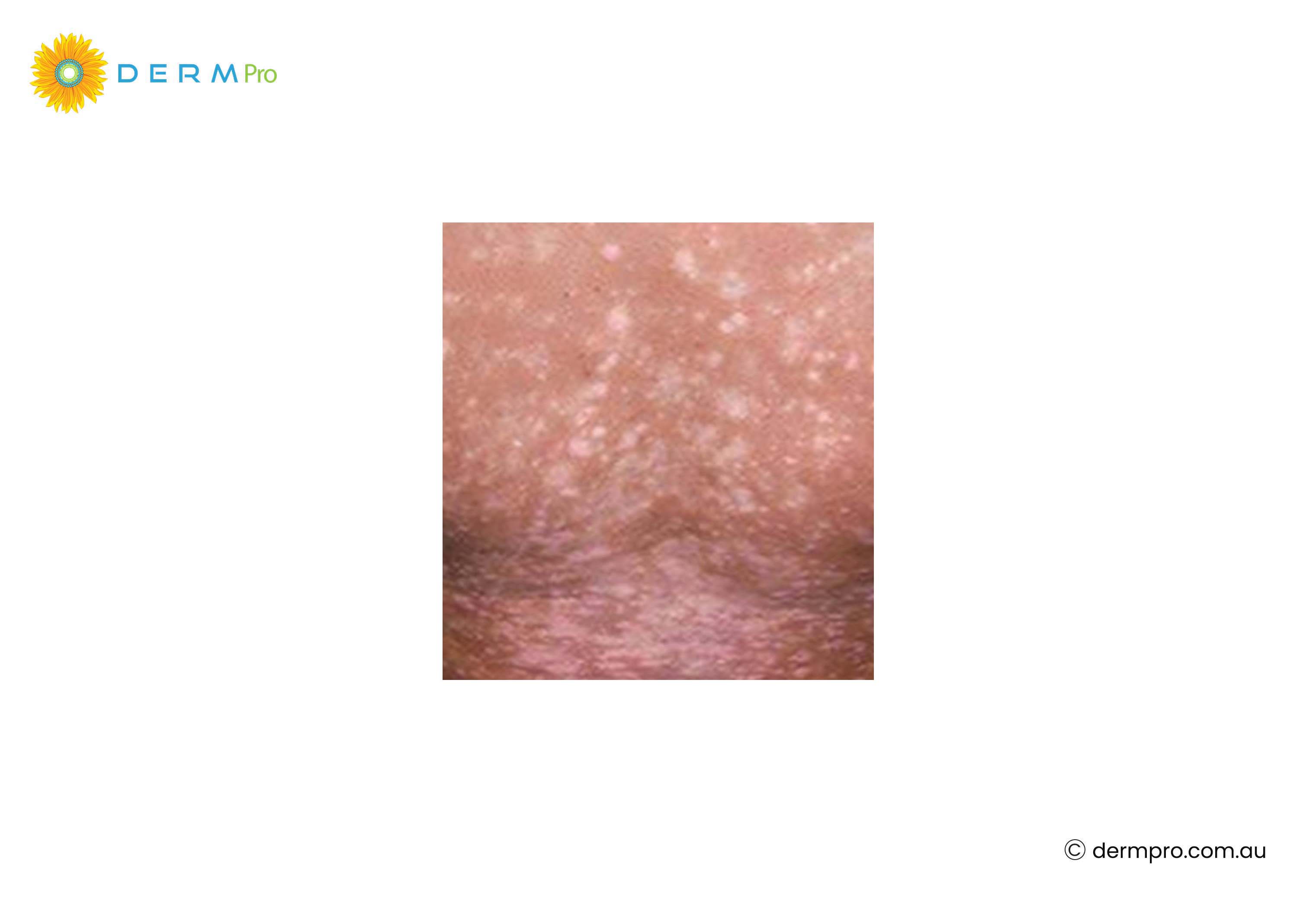 post-inflammatory hypopigmentation