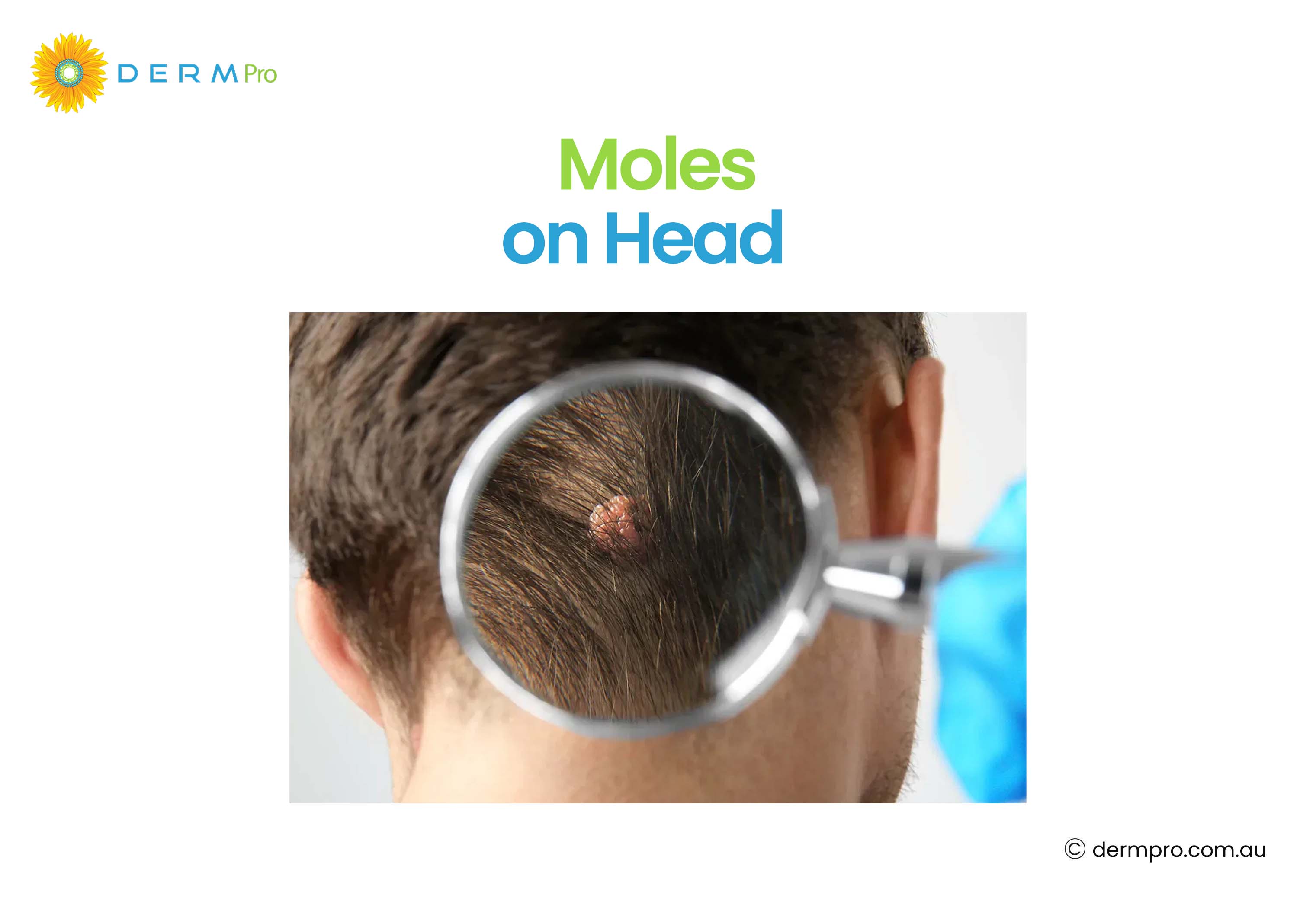 Moles on Head
