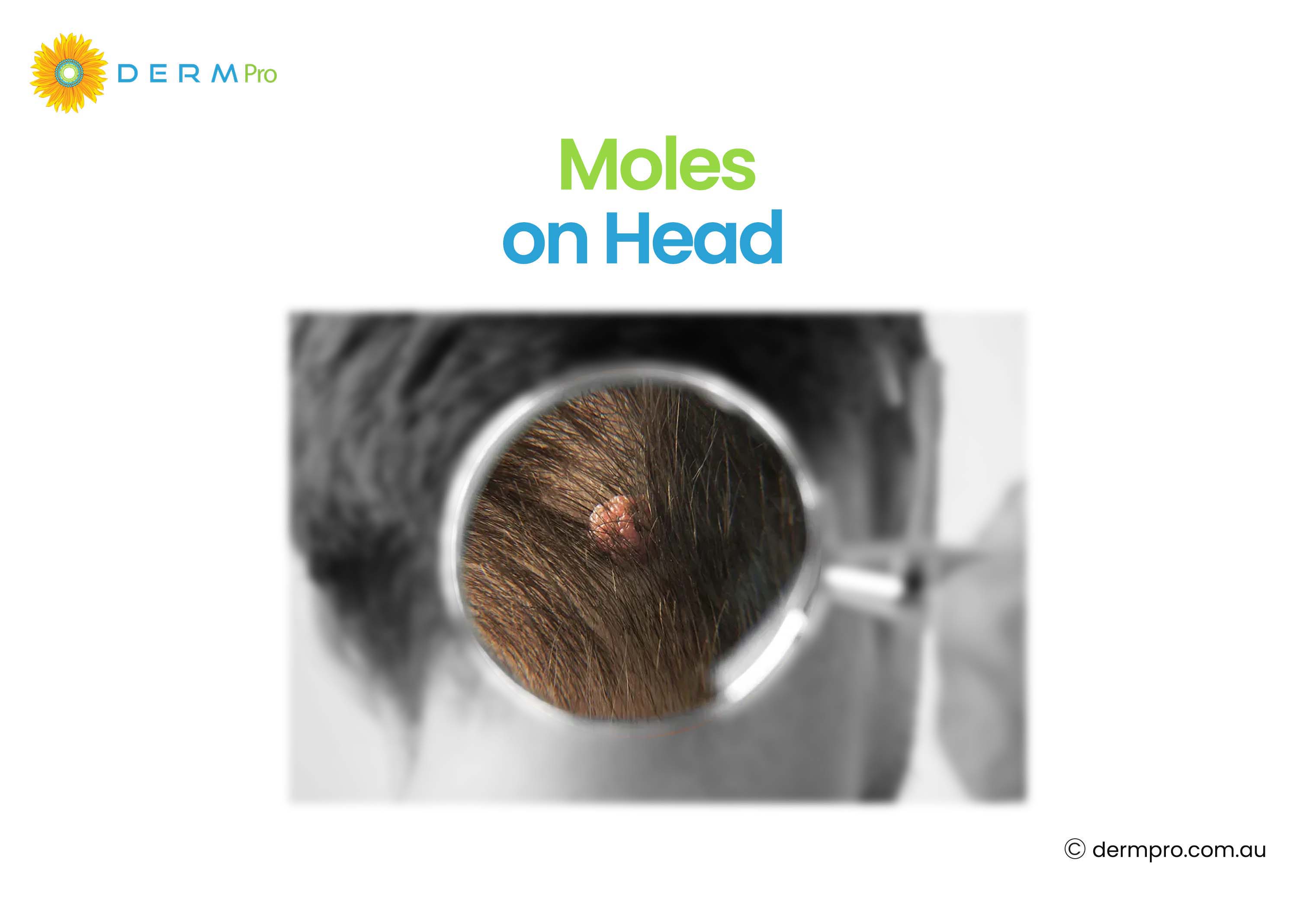 mole on heads 