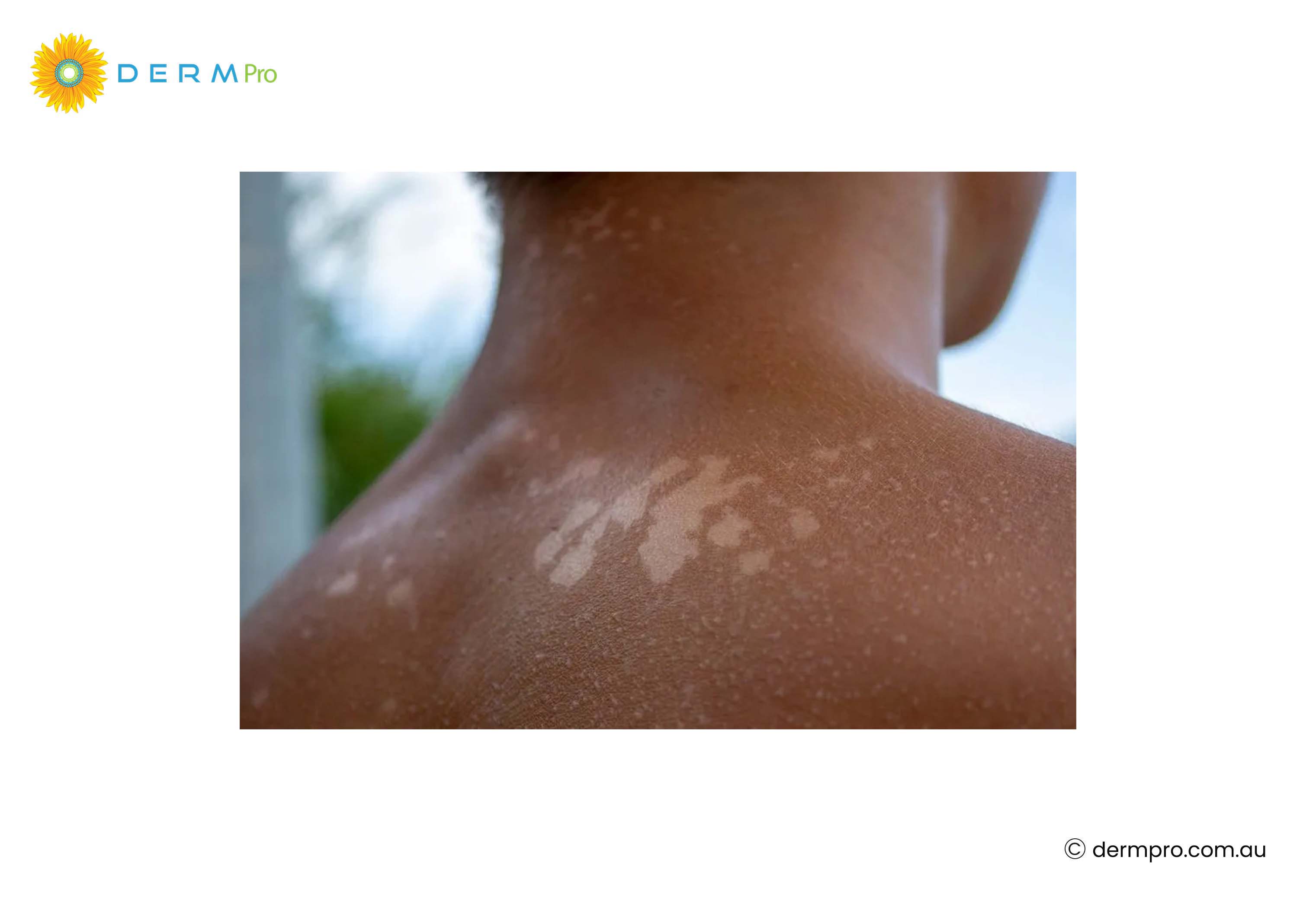 Sun-Related White Spots