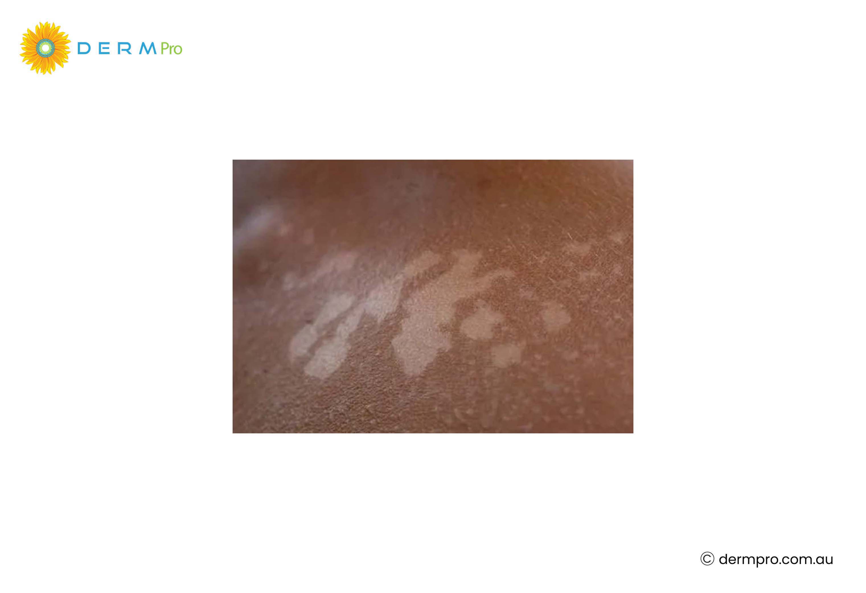 sun related white spots