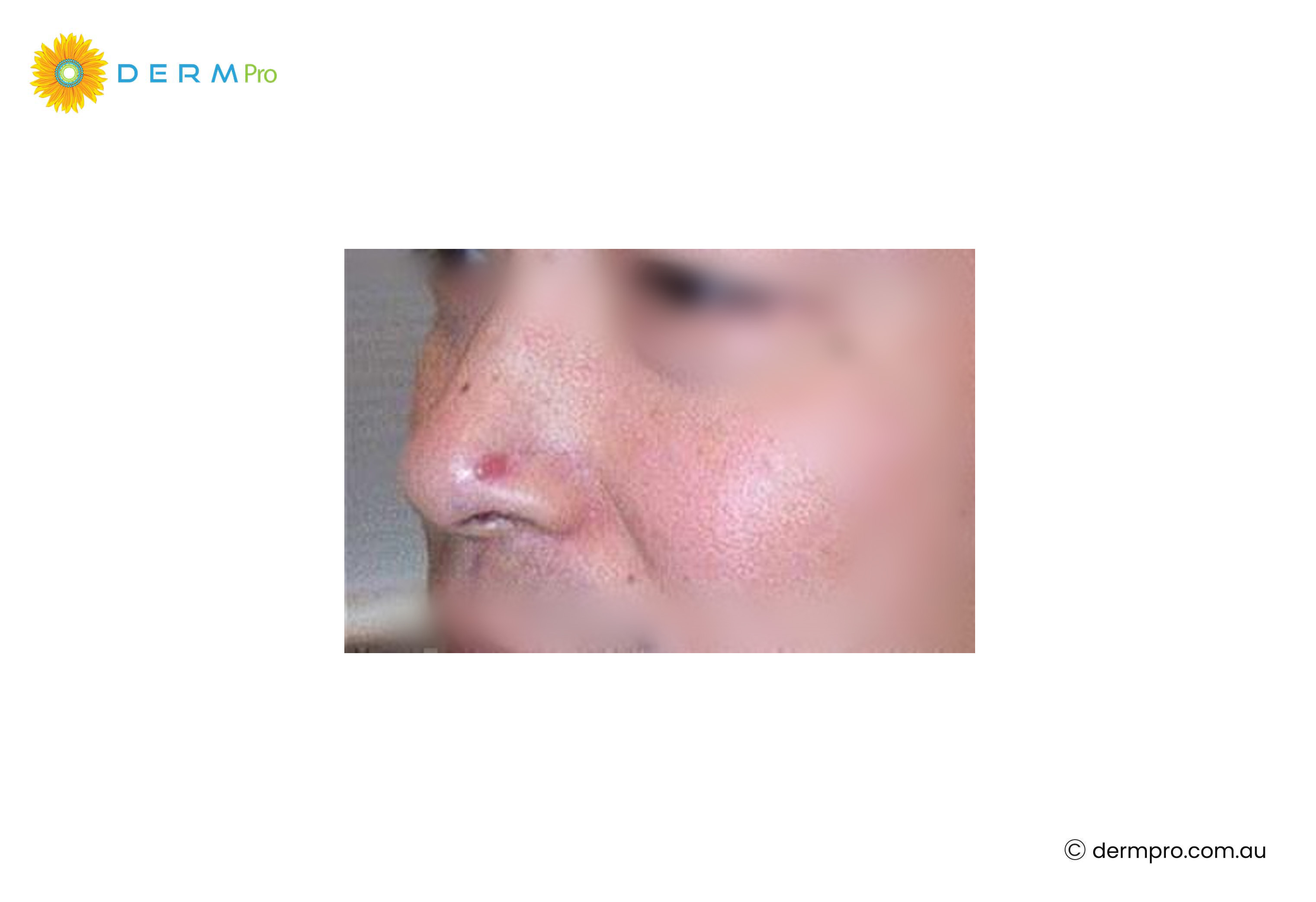 skin cancer on nose 
