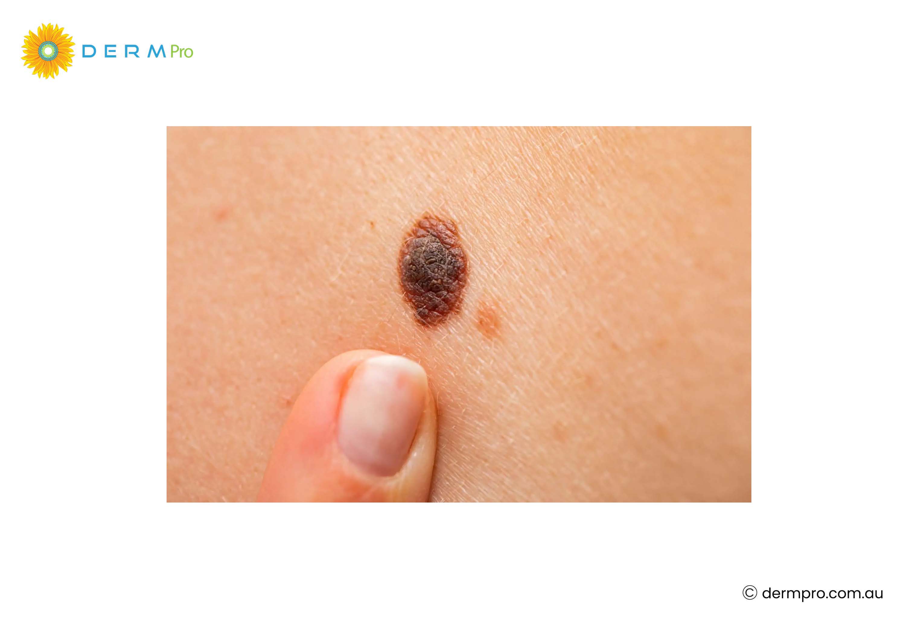 itchy mole: causes, signs and treatment