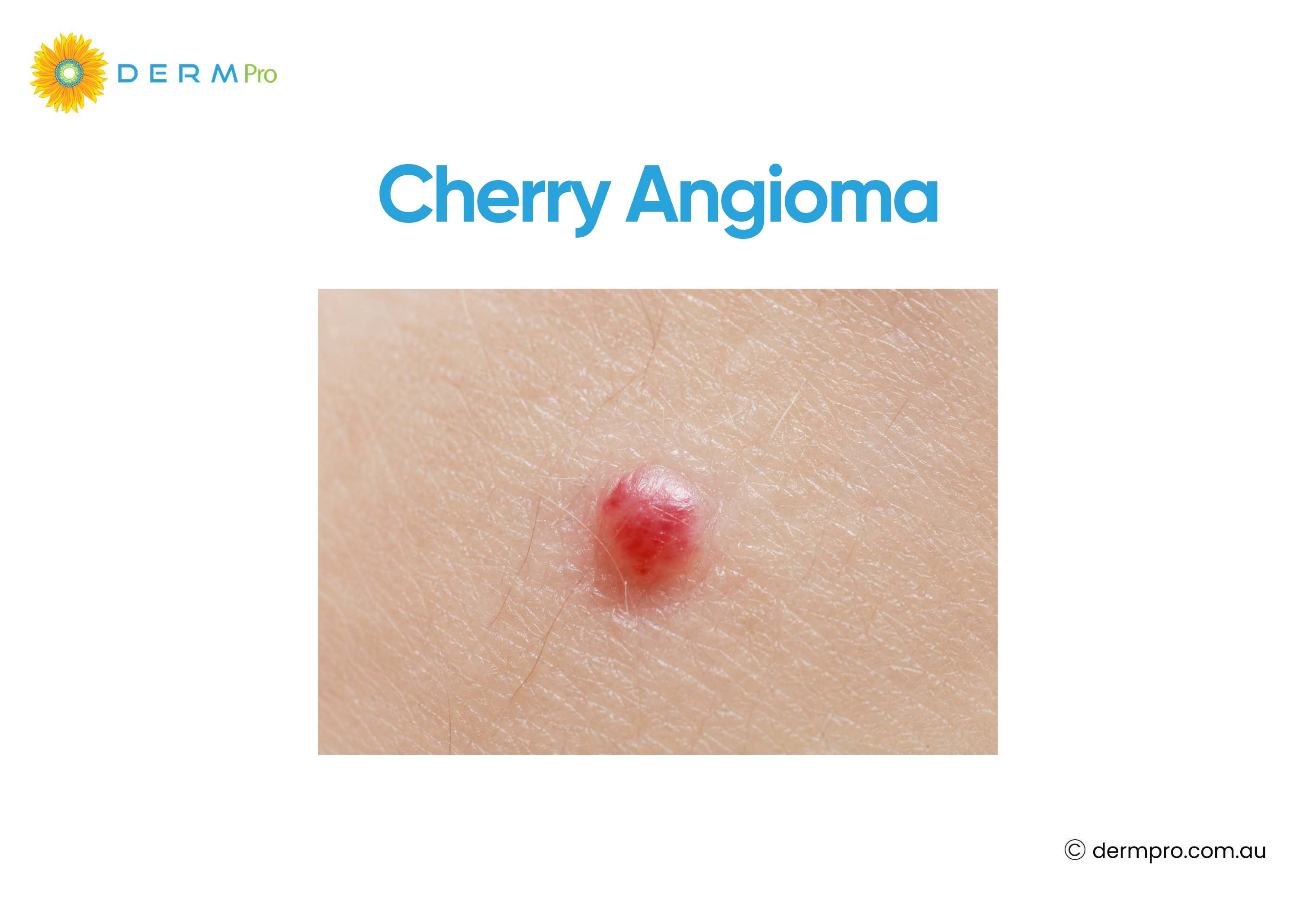 Cherry Angioma 