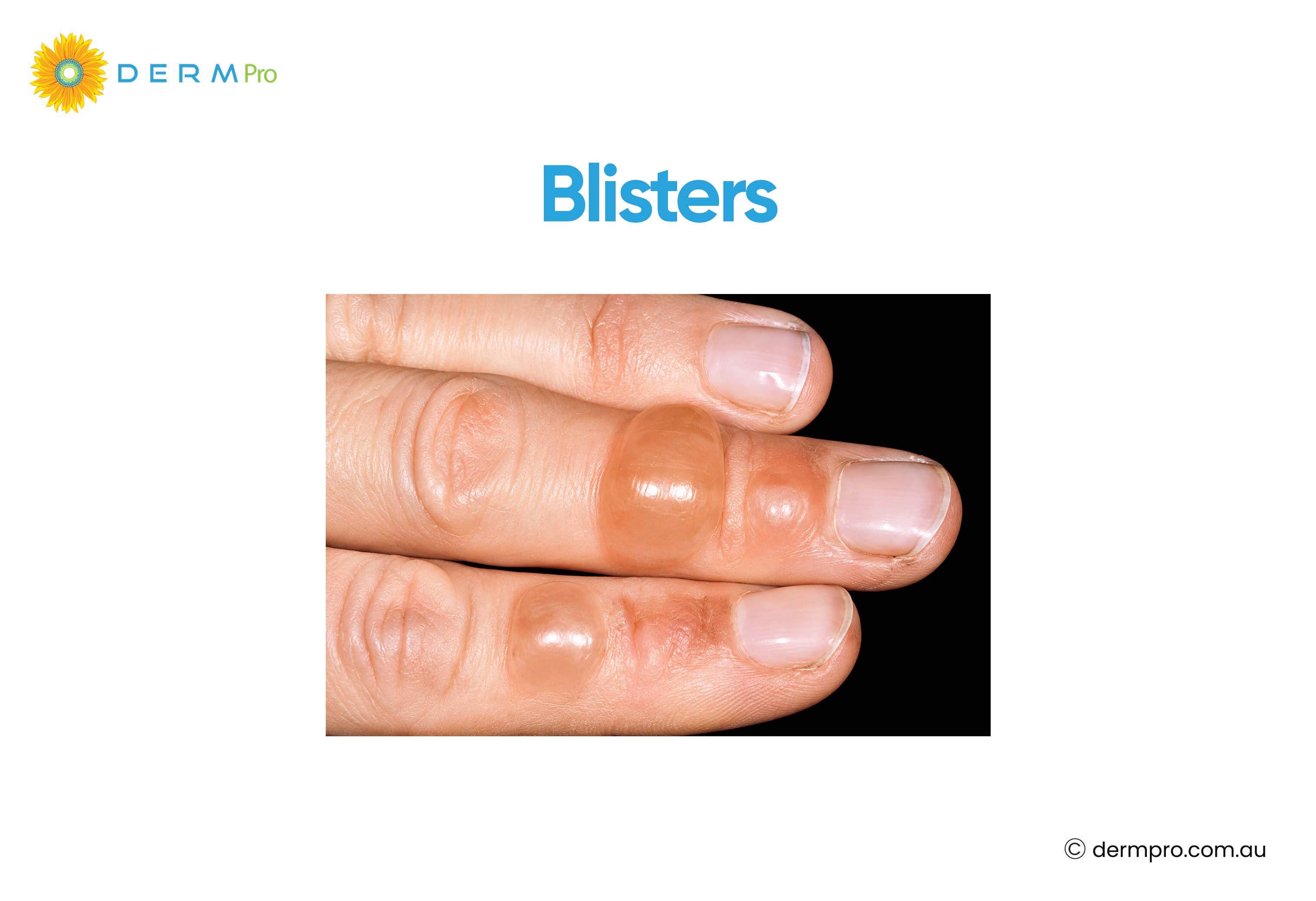 Blisters: How to get rid of it?