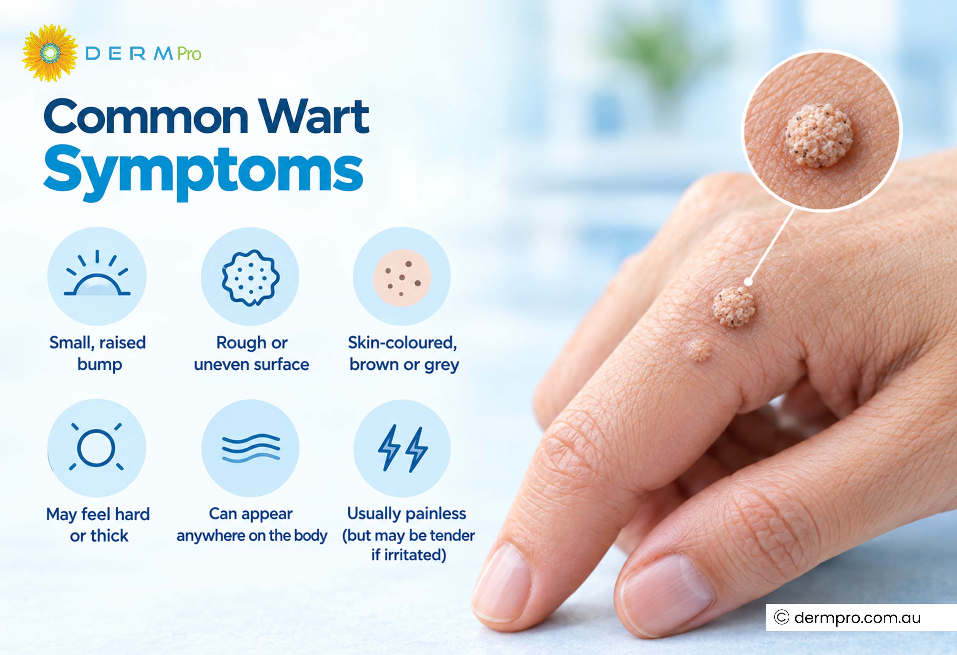 common warts symptoms