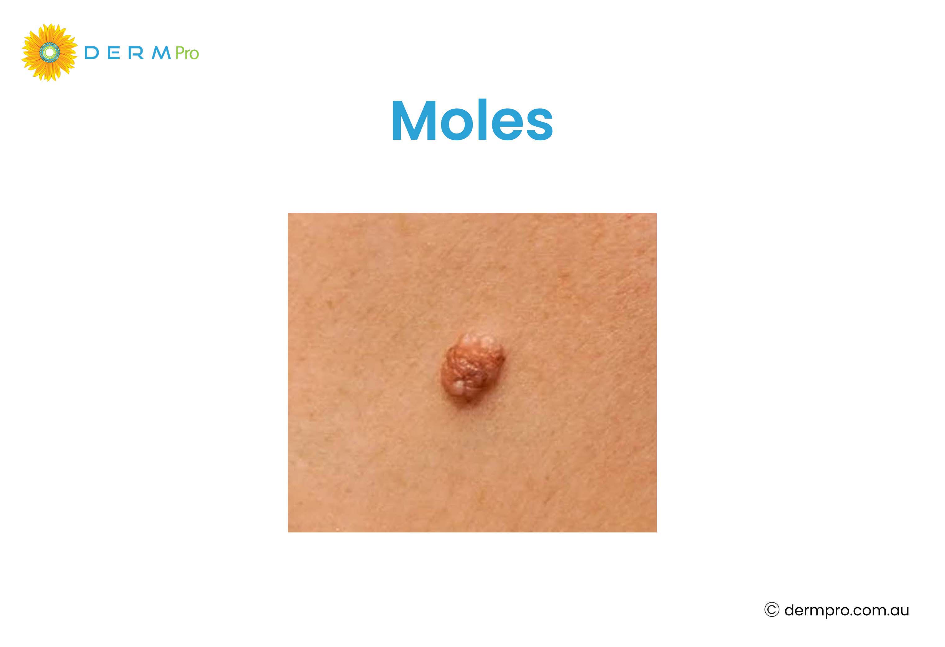 Moles 