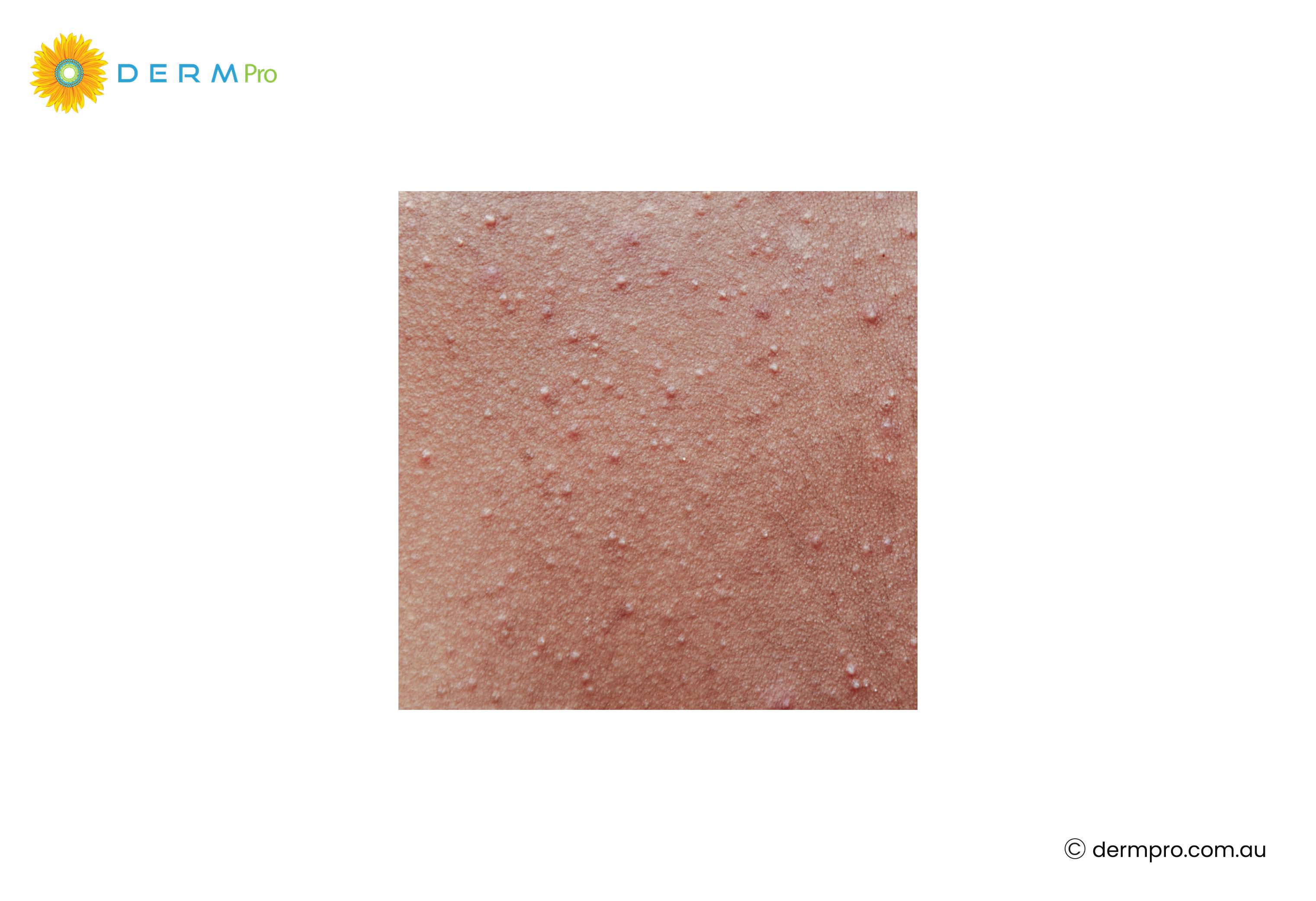 Milia and Small White Bumps