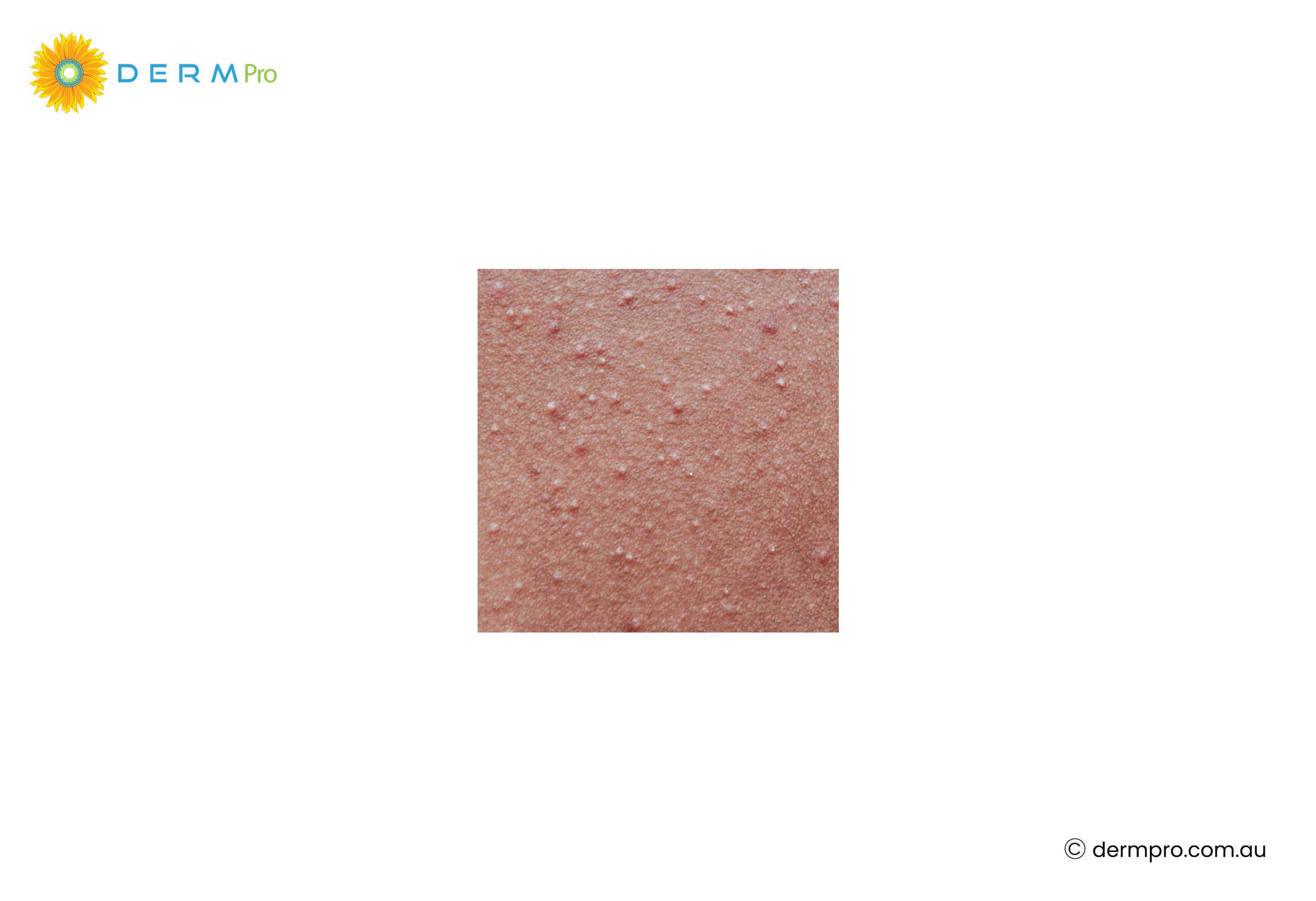 milia and small white bumps