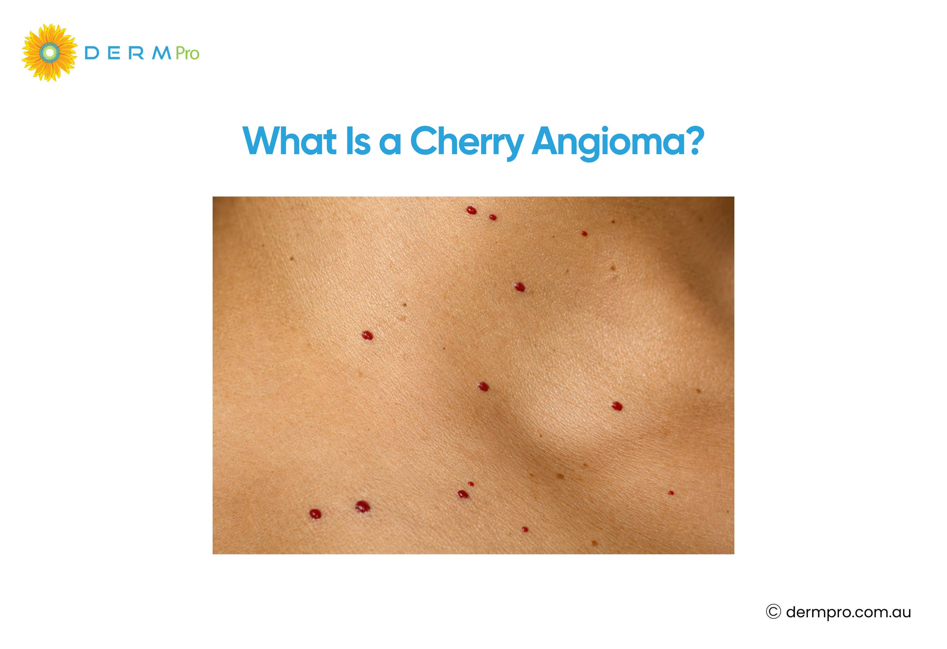 what is Cherry Angioma?