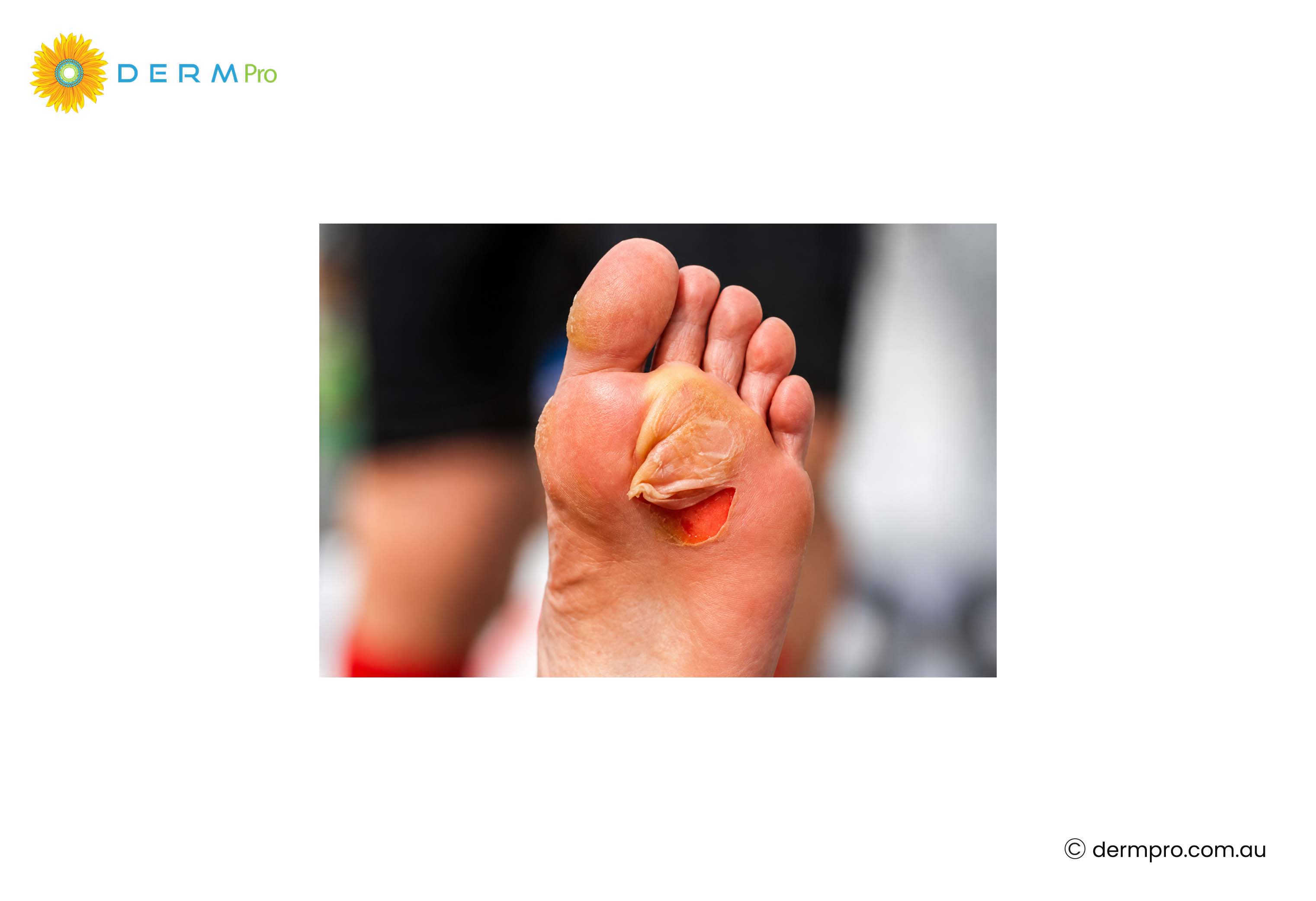 how to get rid of blisters