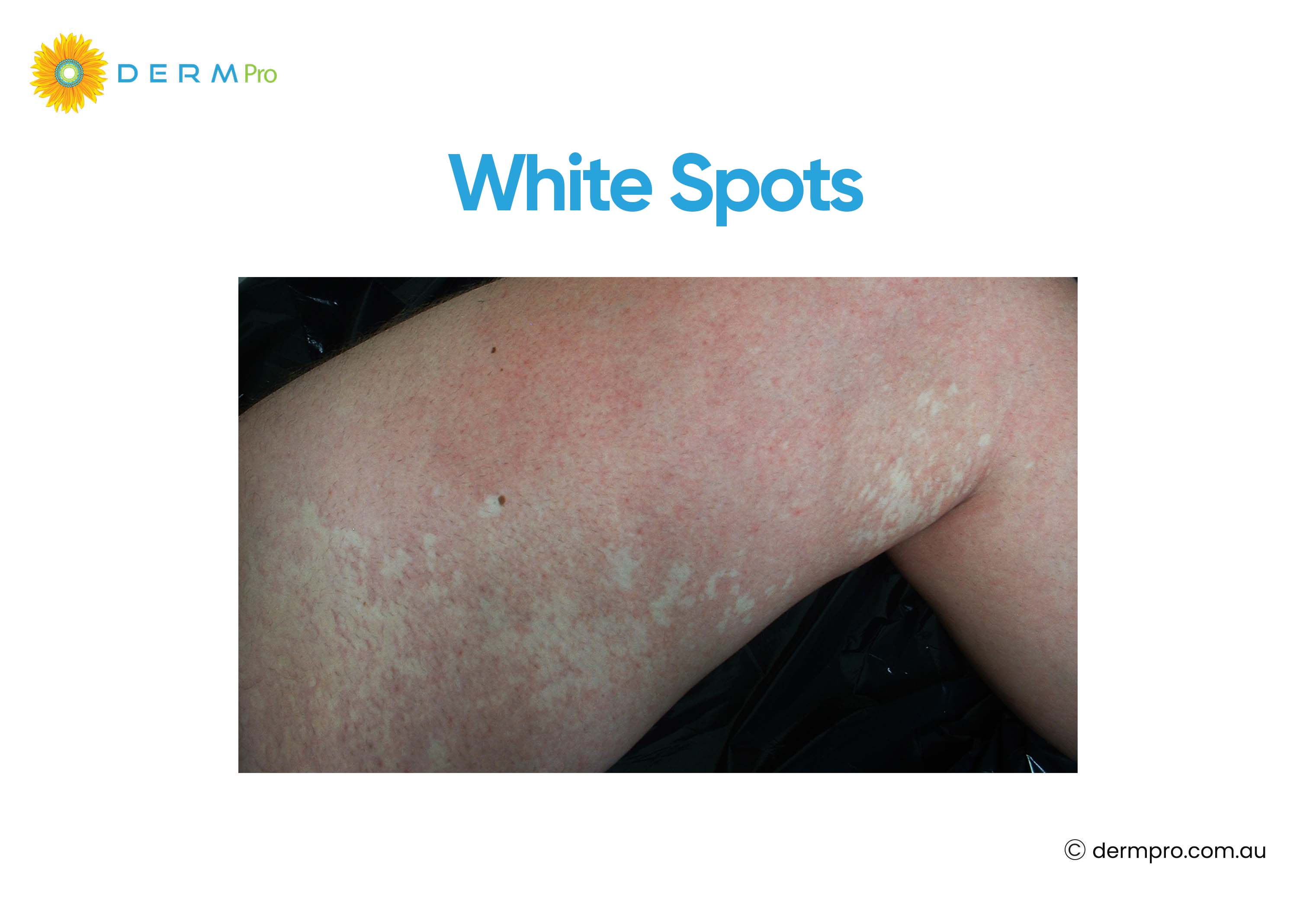 image of white spots on skin 