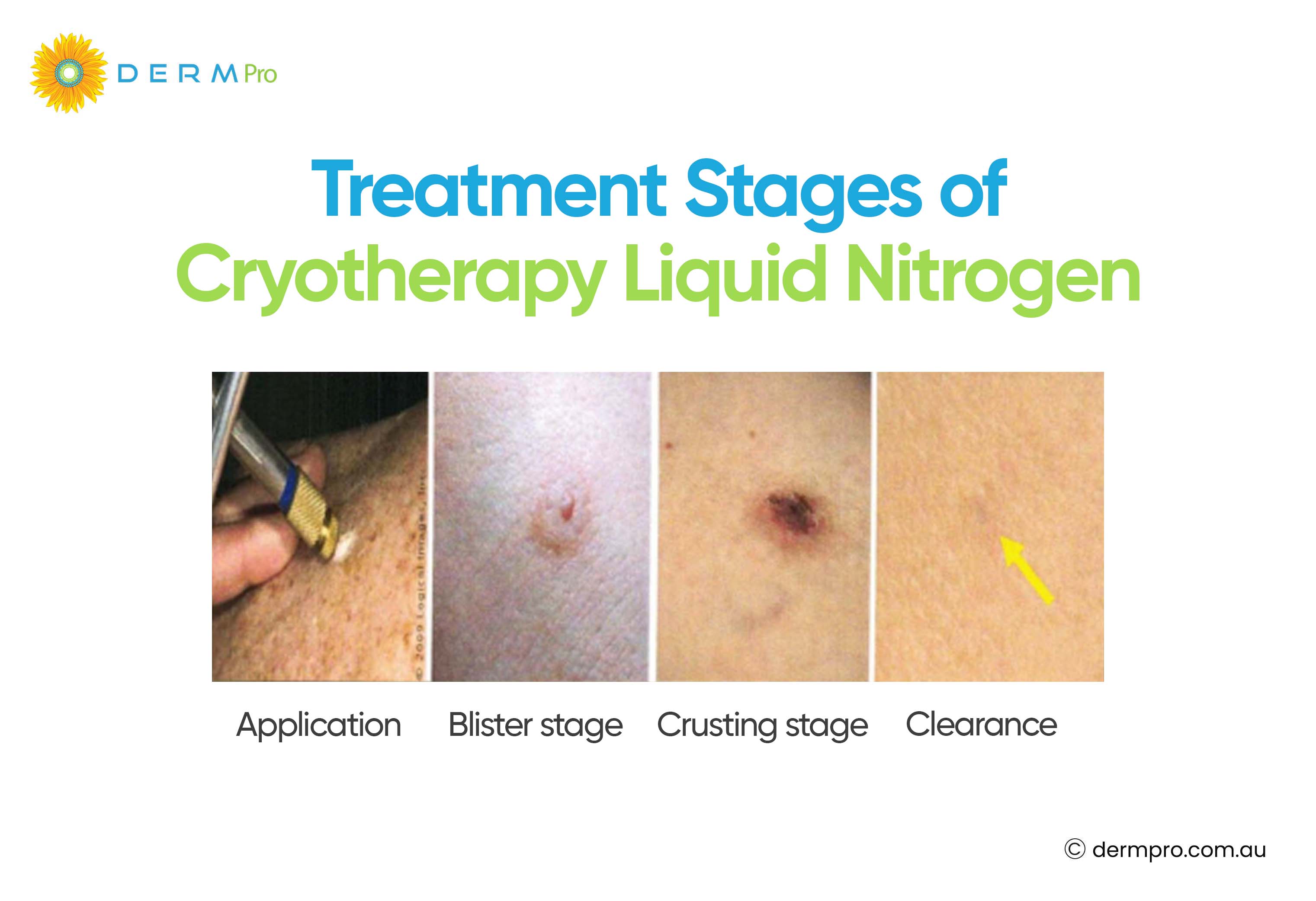 treatment of cryotherapy 