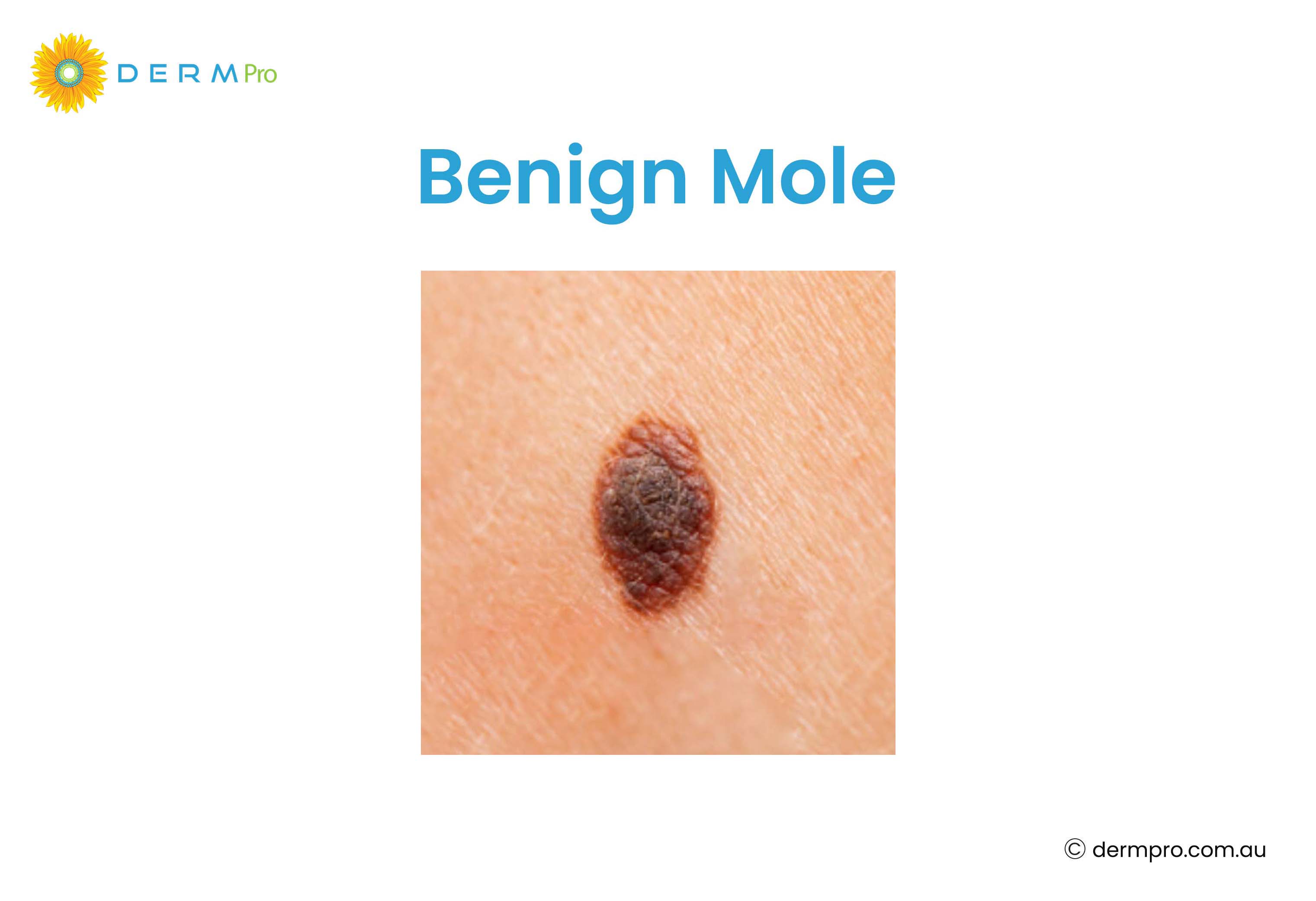 Benign Mole 