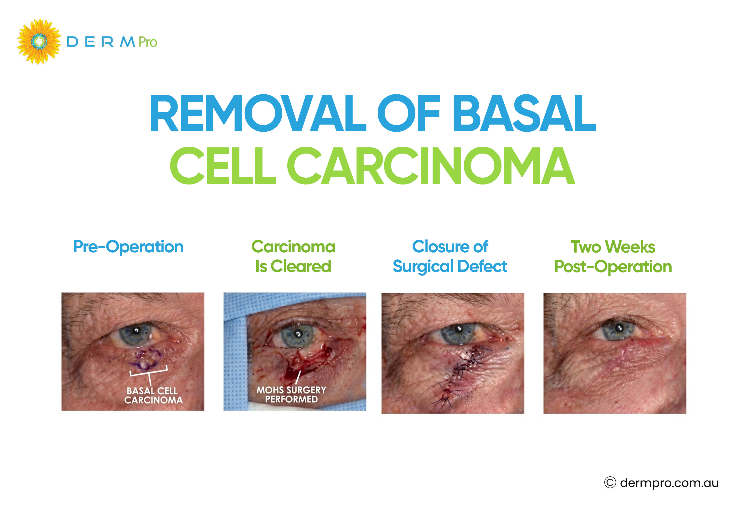 Removal of Basal Cell Carcinoma