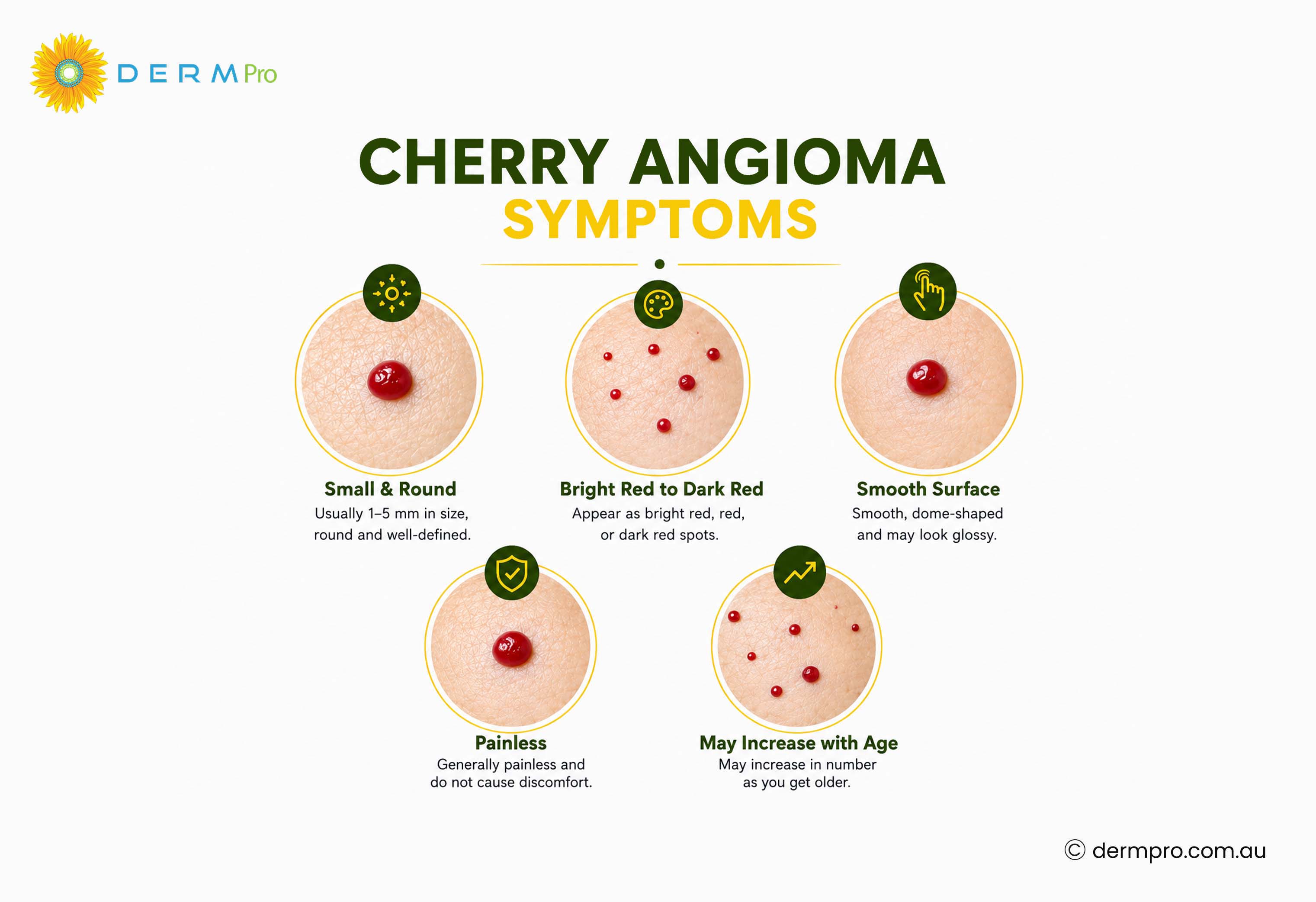 cherry angioma symptoms 