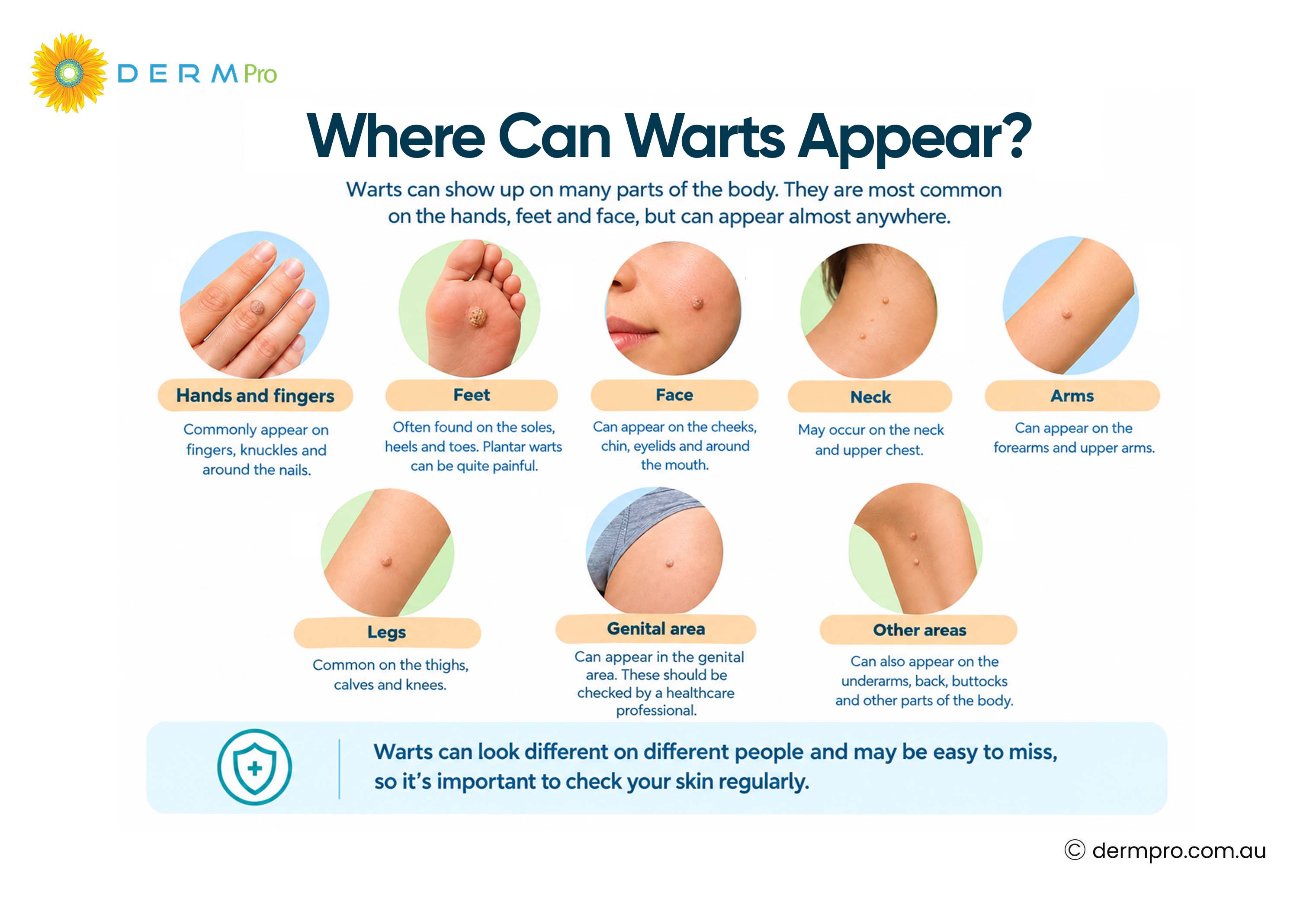 where can warts appear