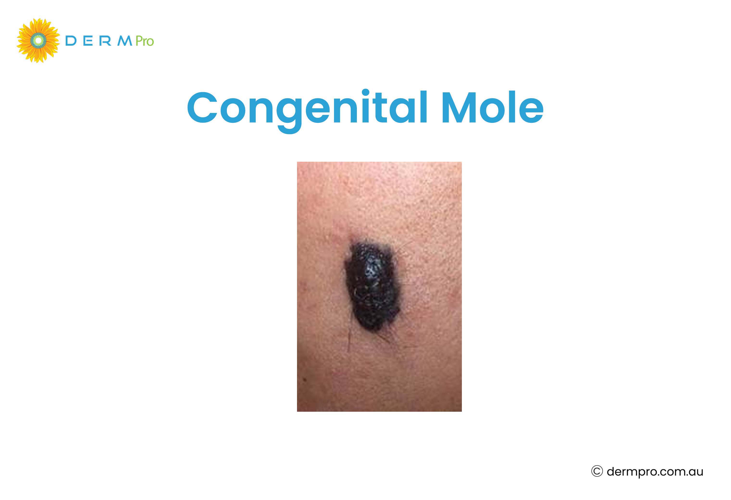 congenital mole 