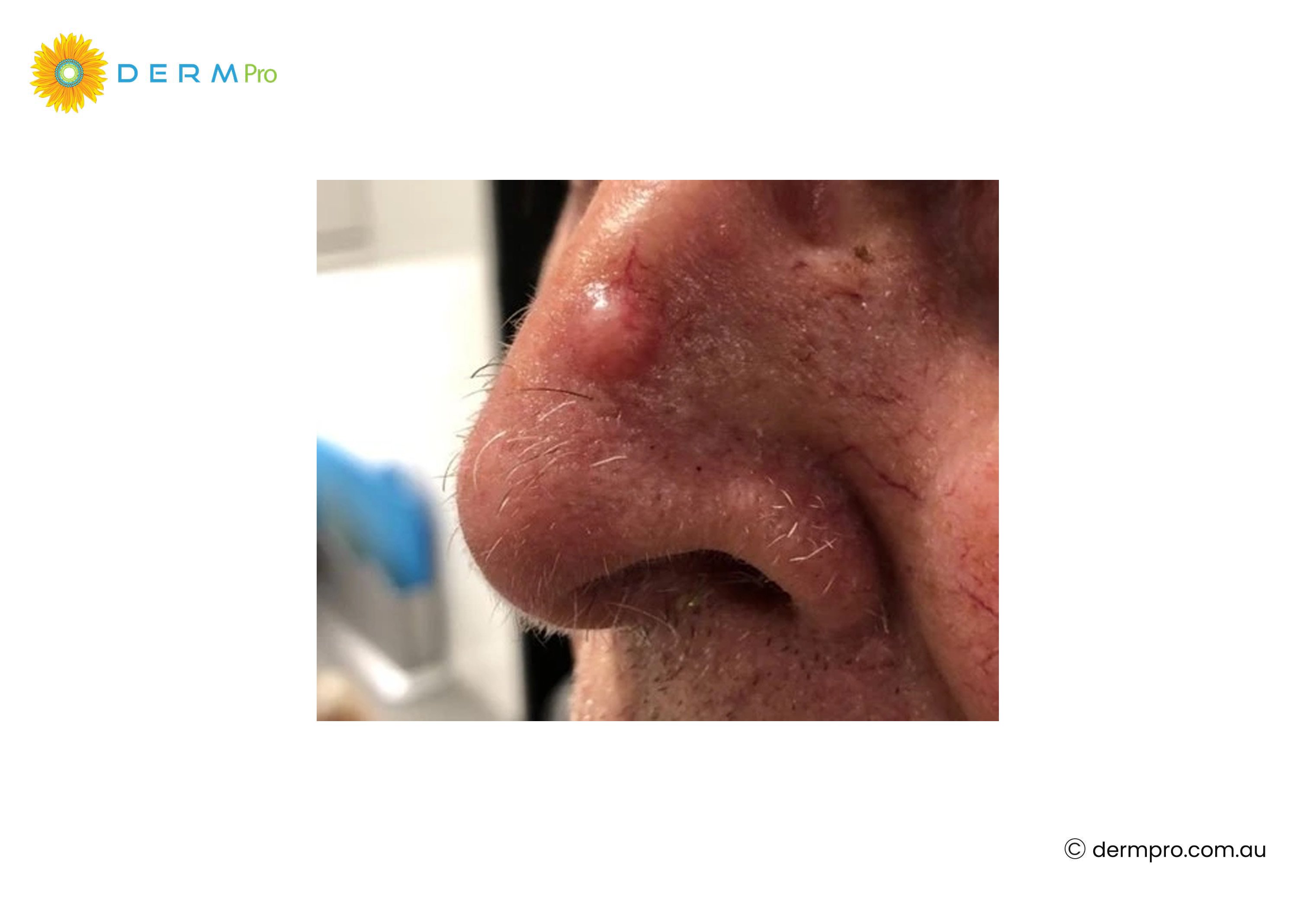 basal cell skin cancer on nose 