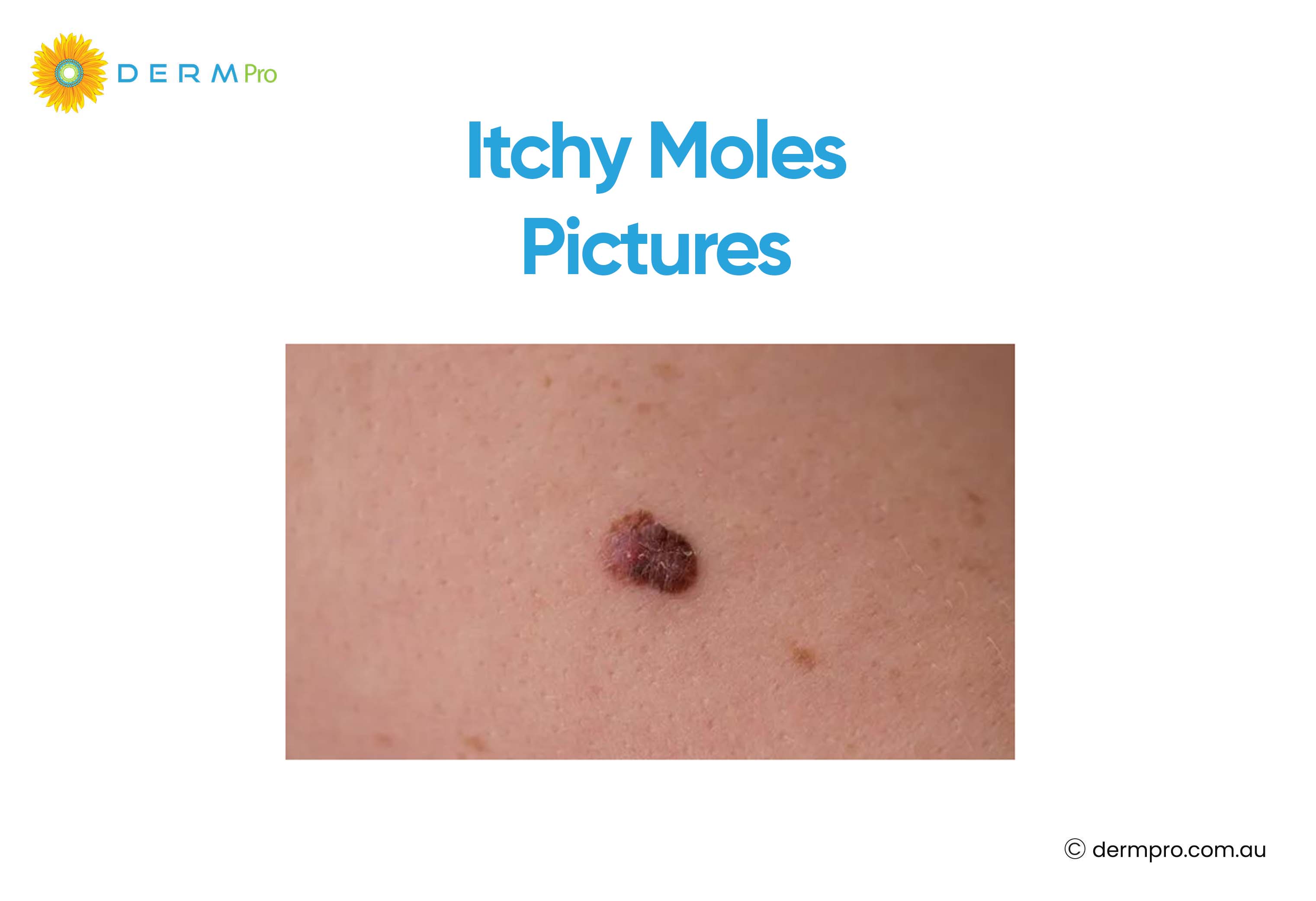 itchy moles pictures