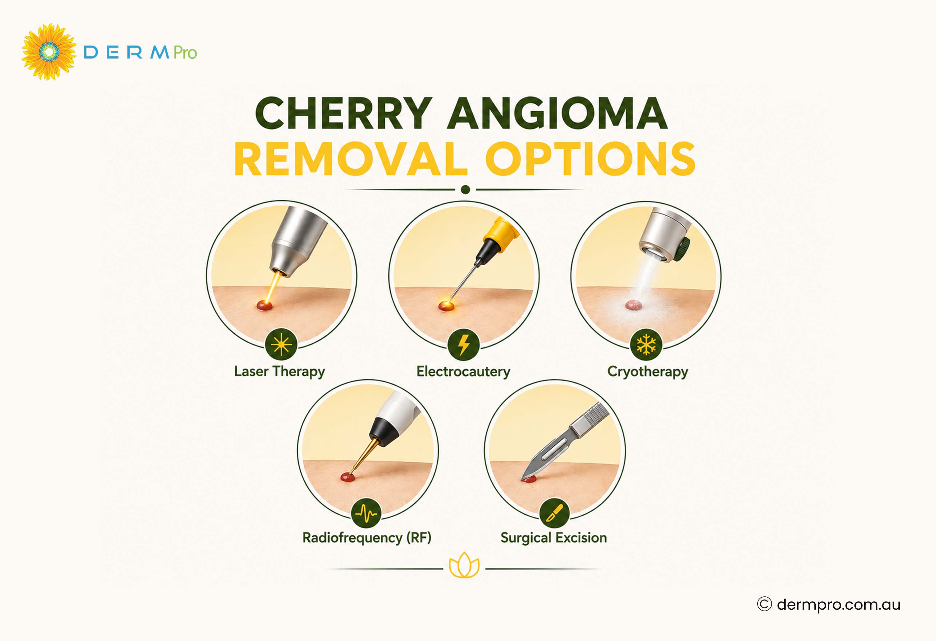 Cherry Angioma Removal Options 