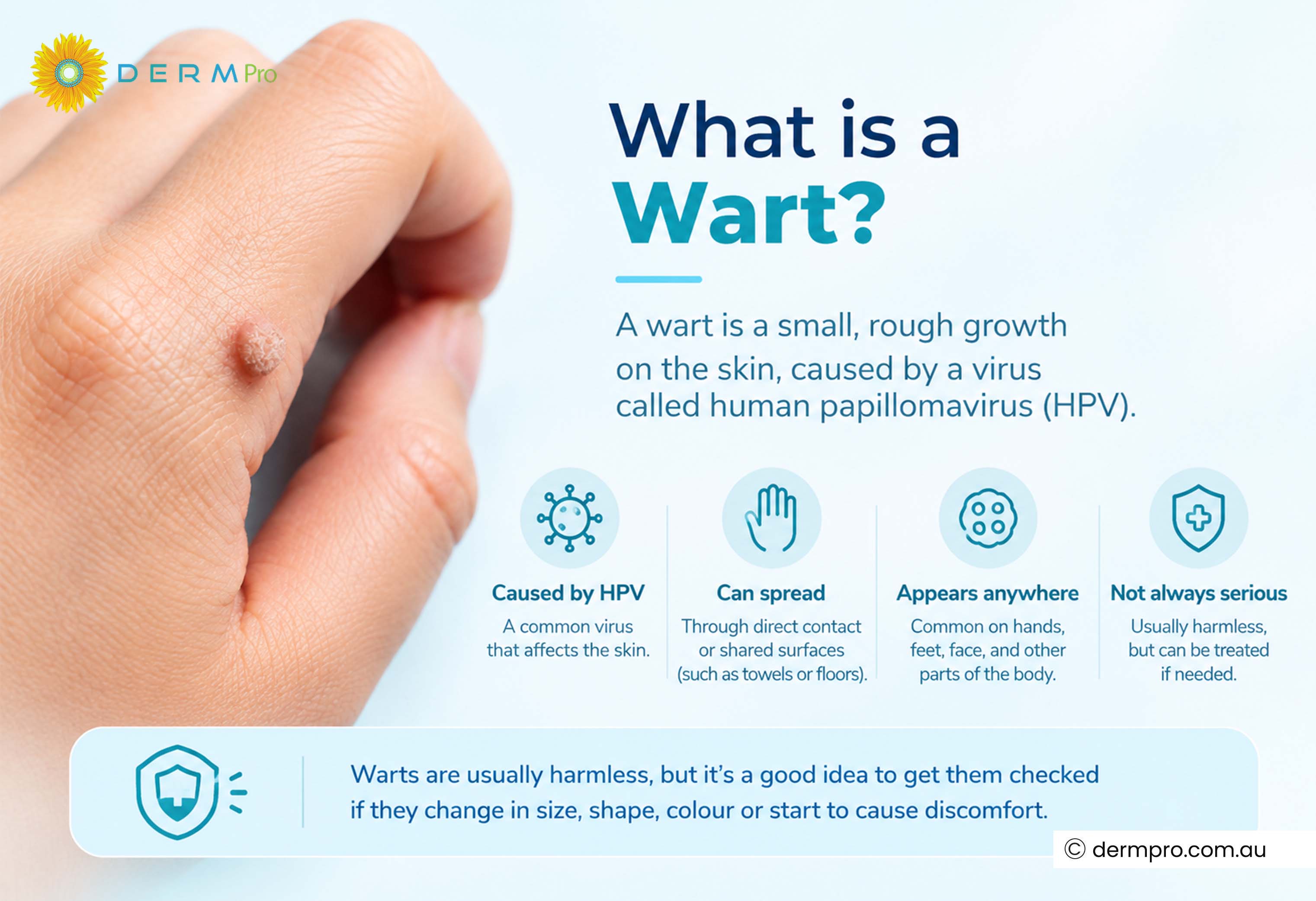 what is wart?