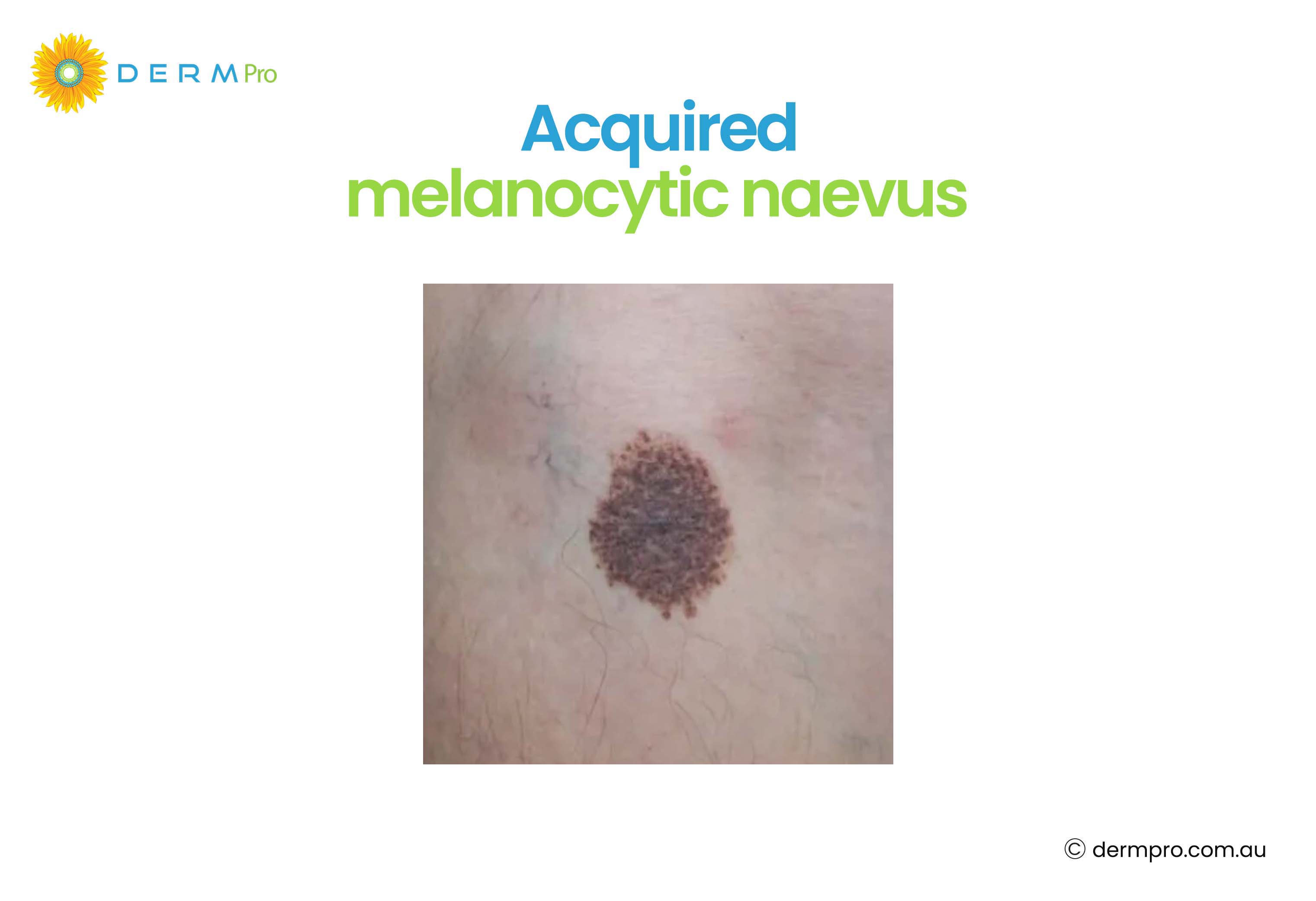 acquired melanocytic naevus