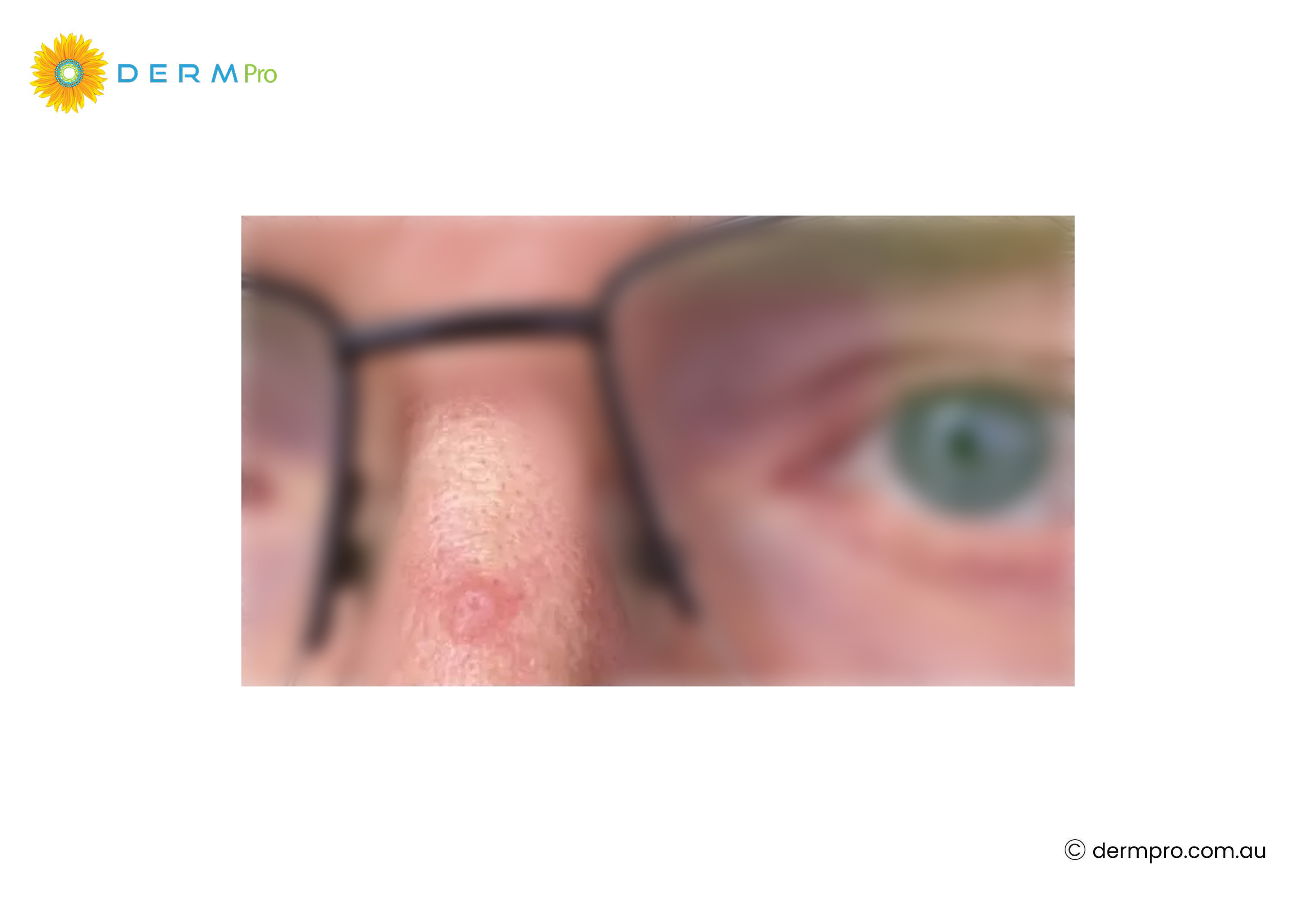 squamous cell skin cancer on nose 