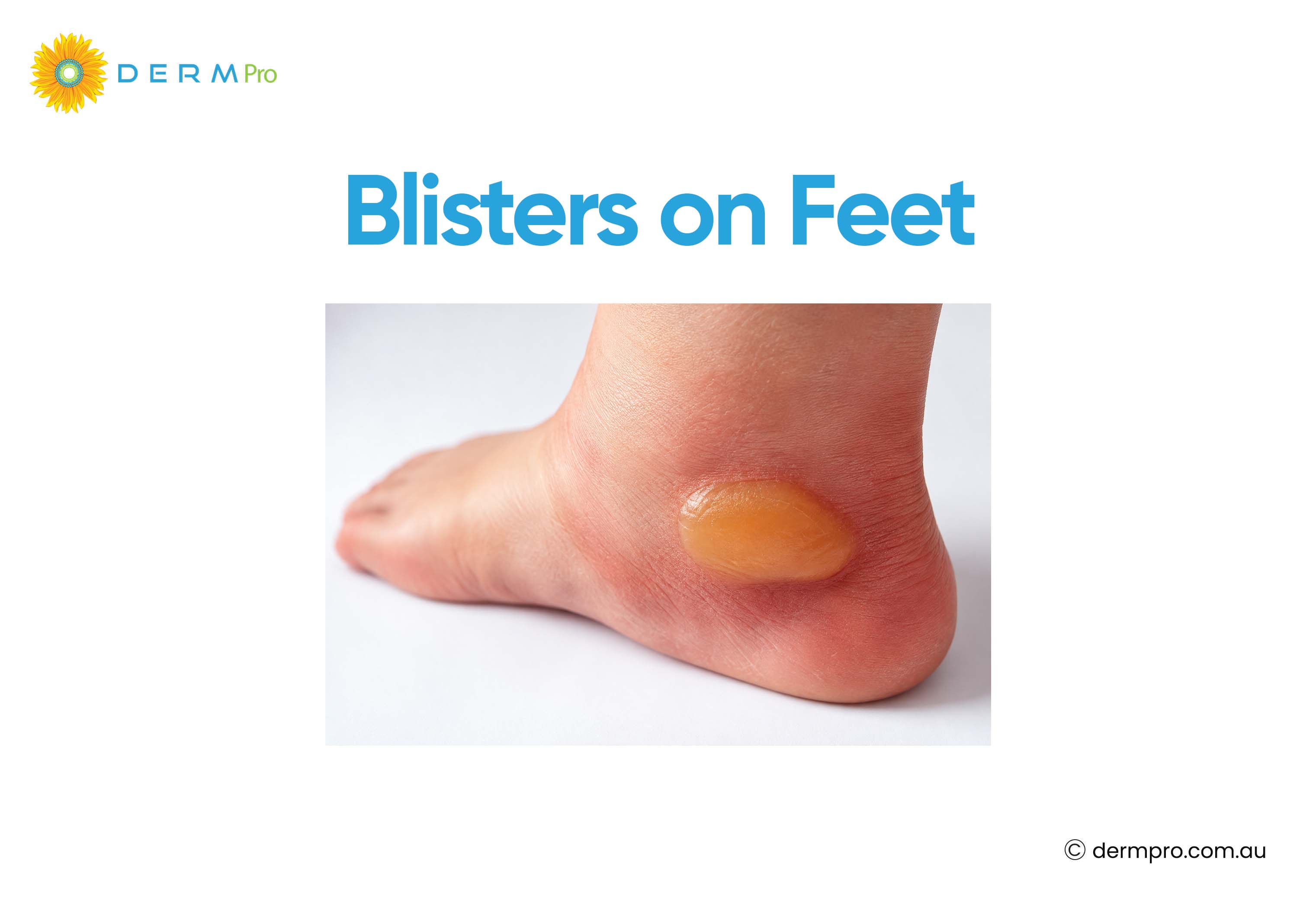blisters on feet 