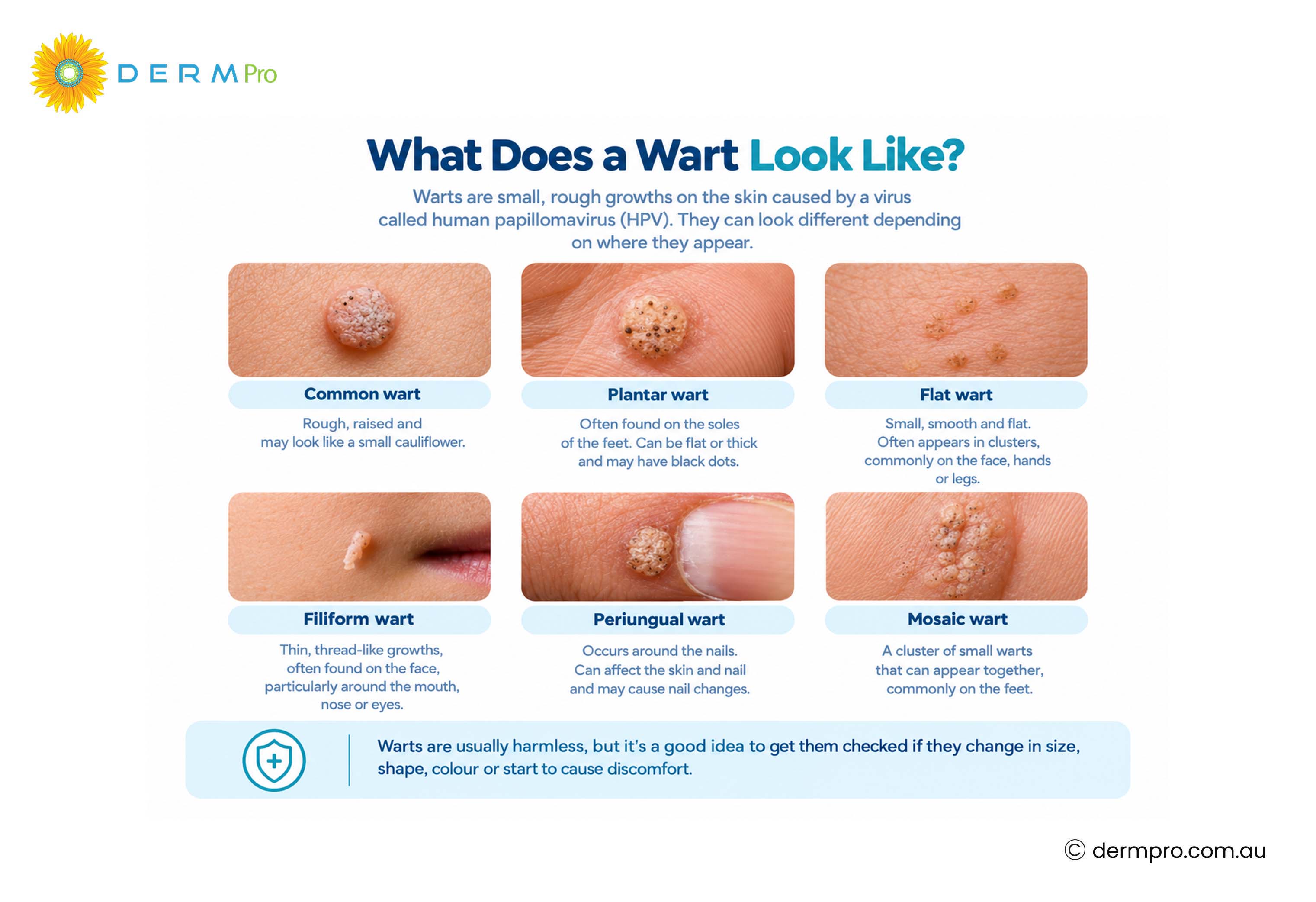 what does a wart look like