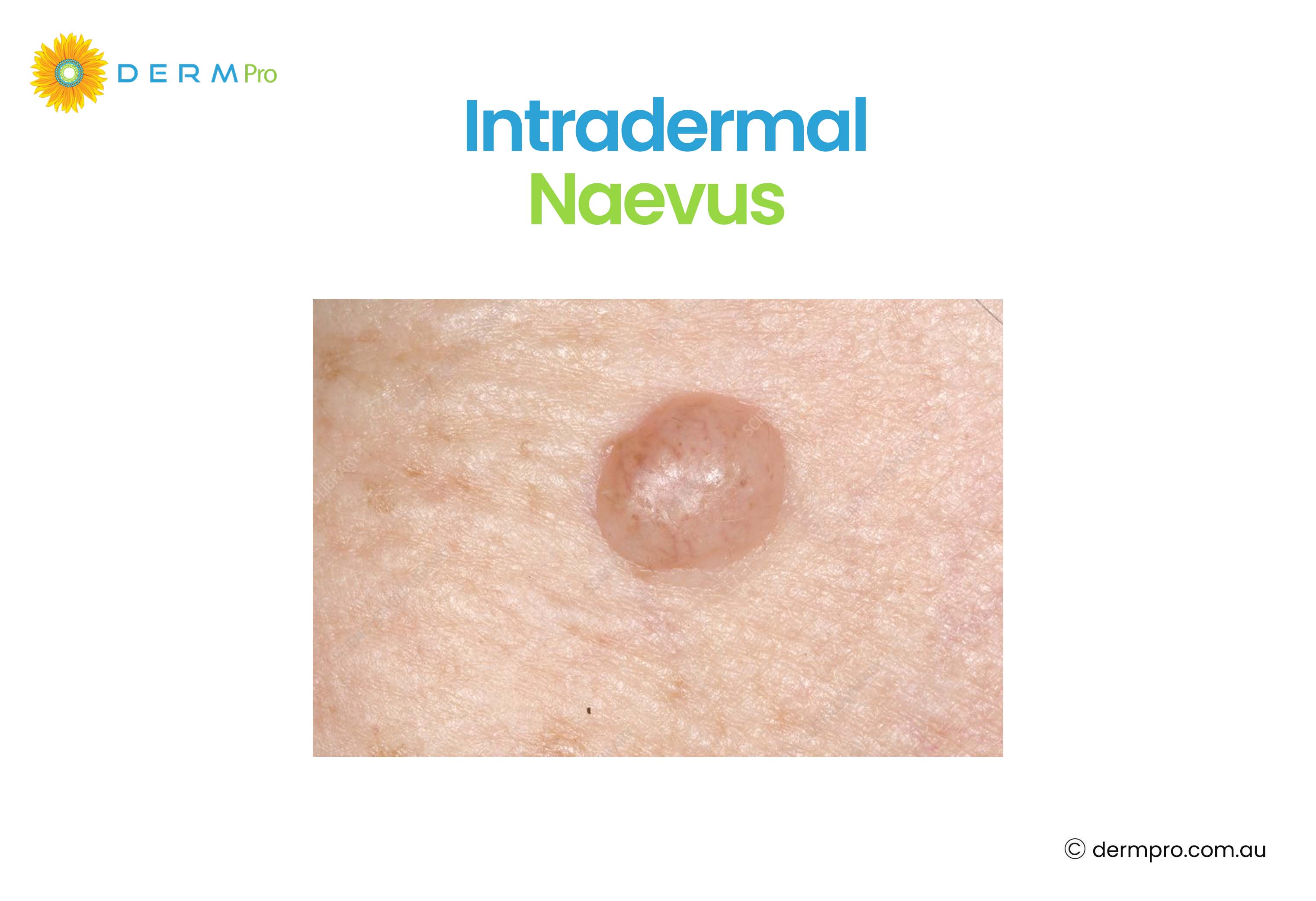 Intradermal Naevus
