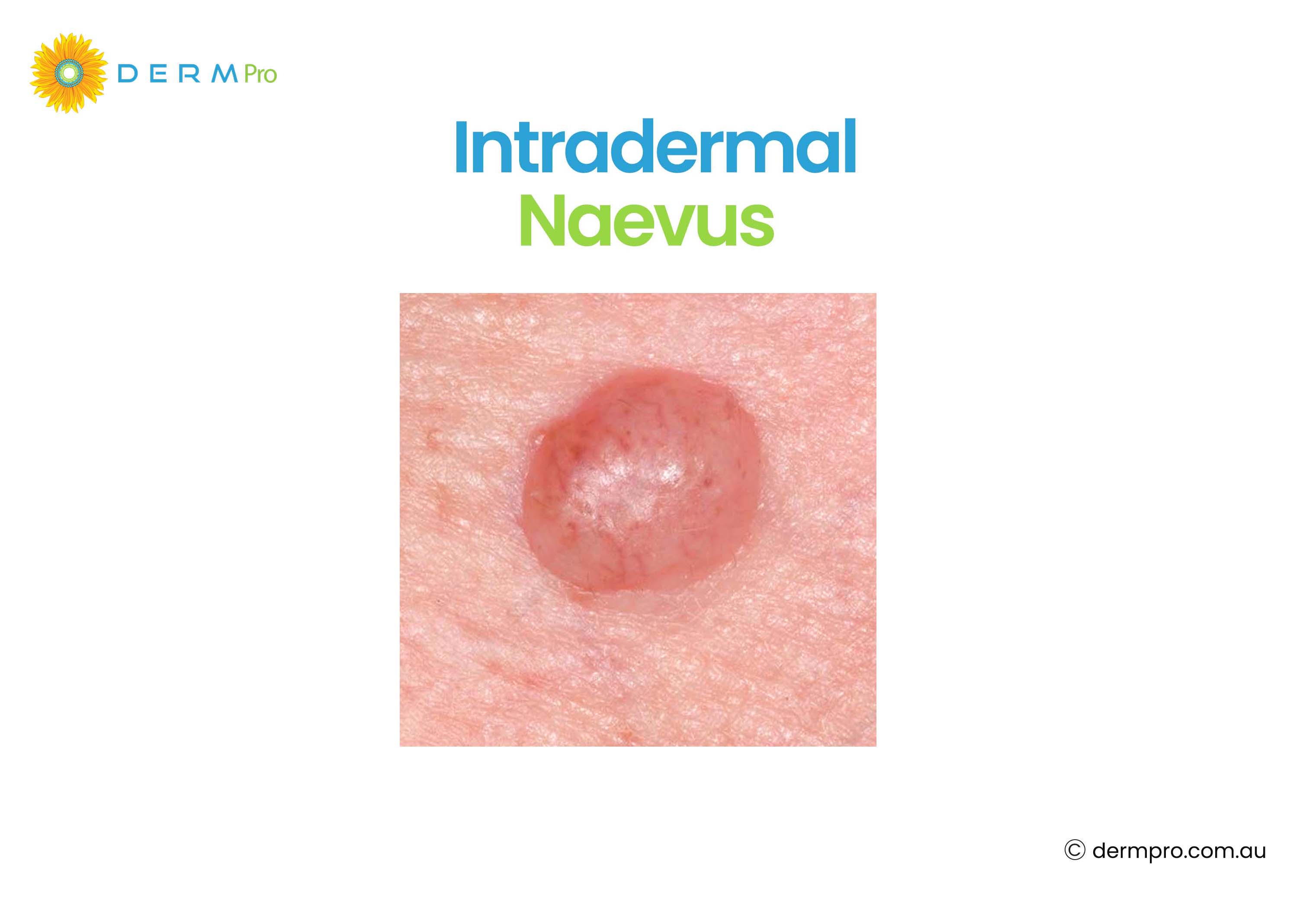 Intradermal Naevus 