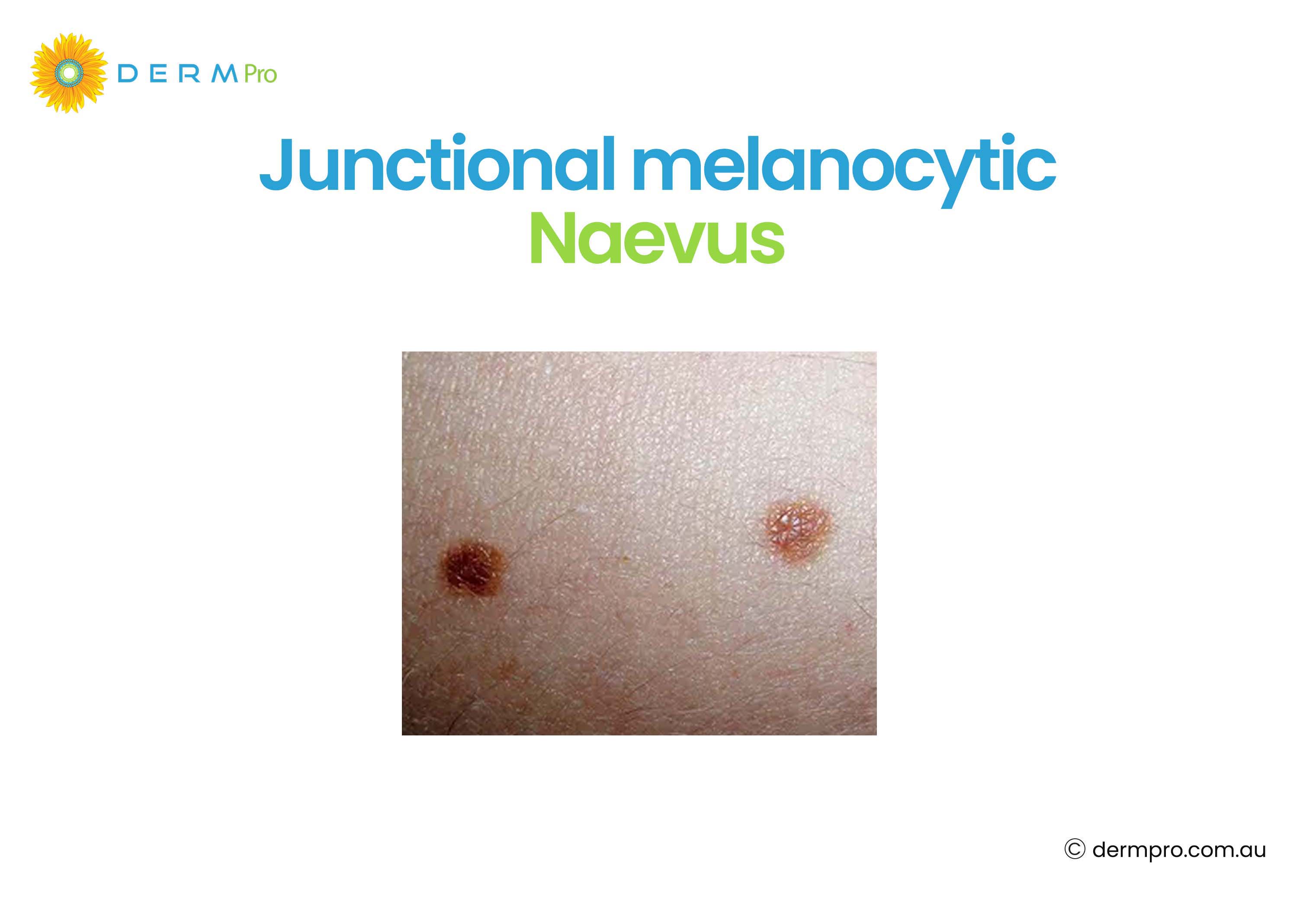 junctional melanocytic naevus 