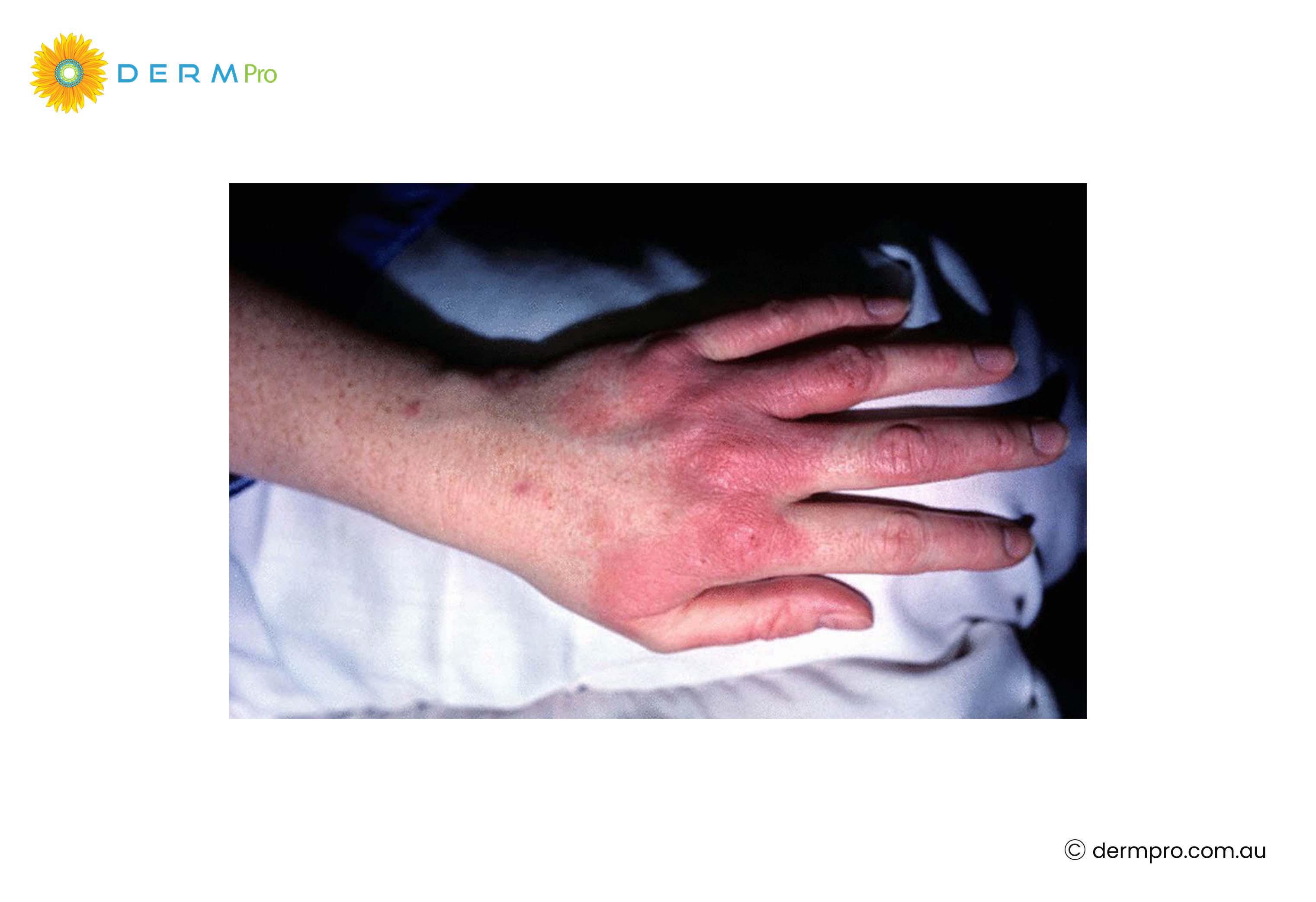 contact dermatitis