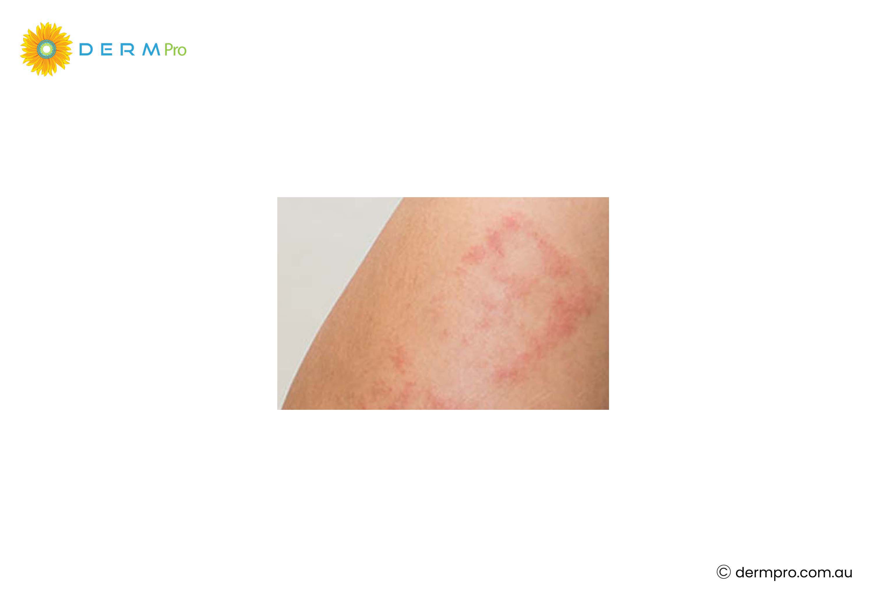 Eczema