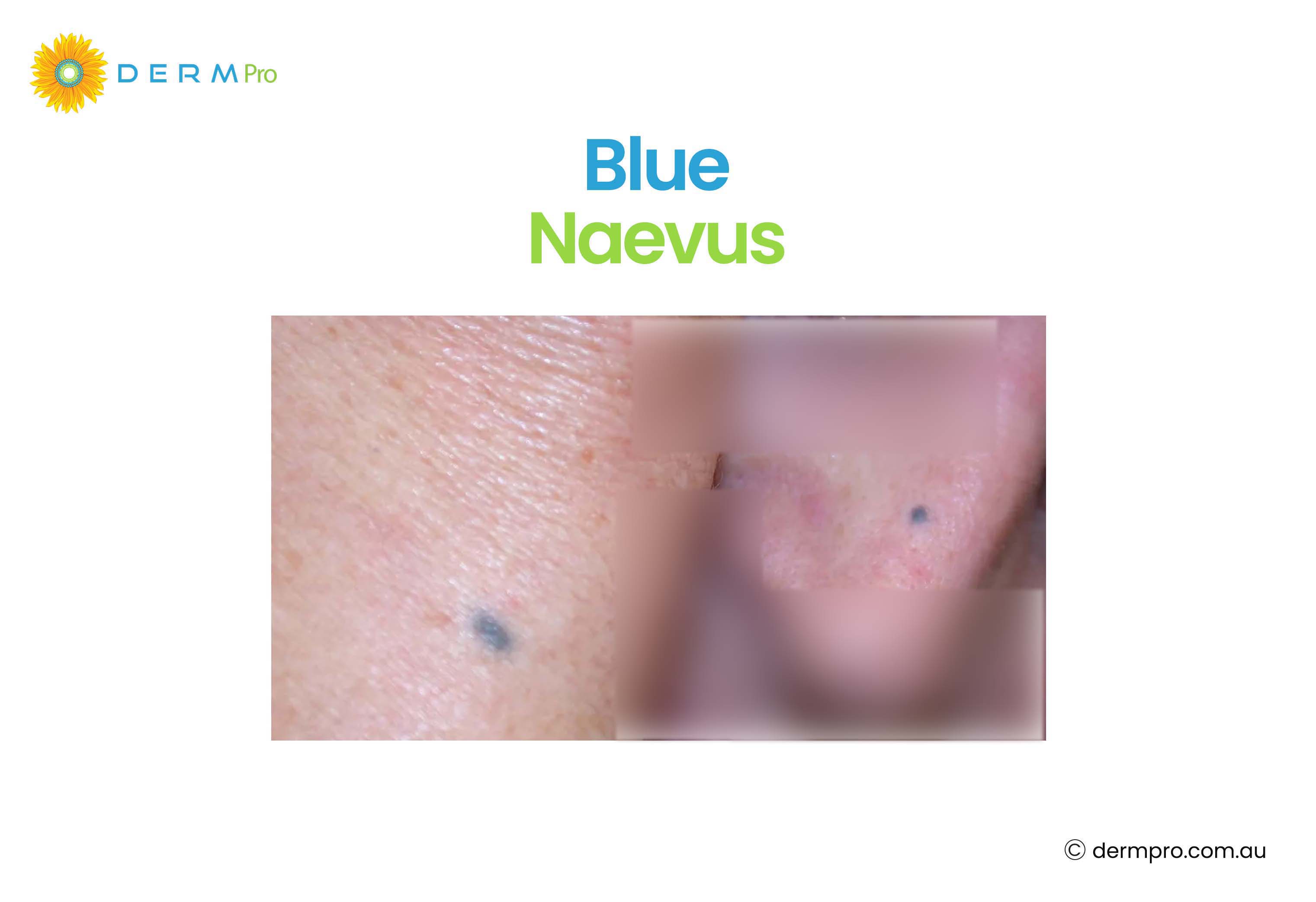 Blue Naevus 