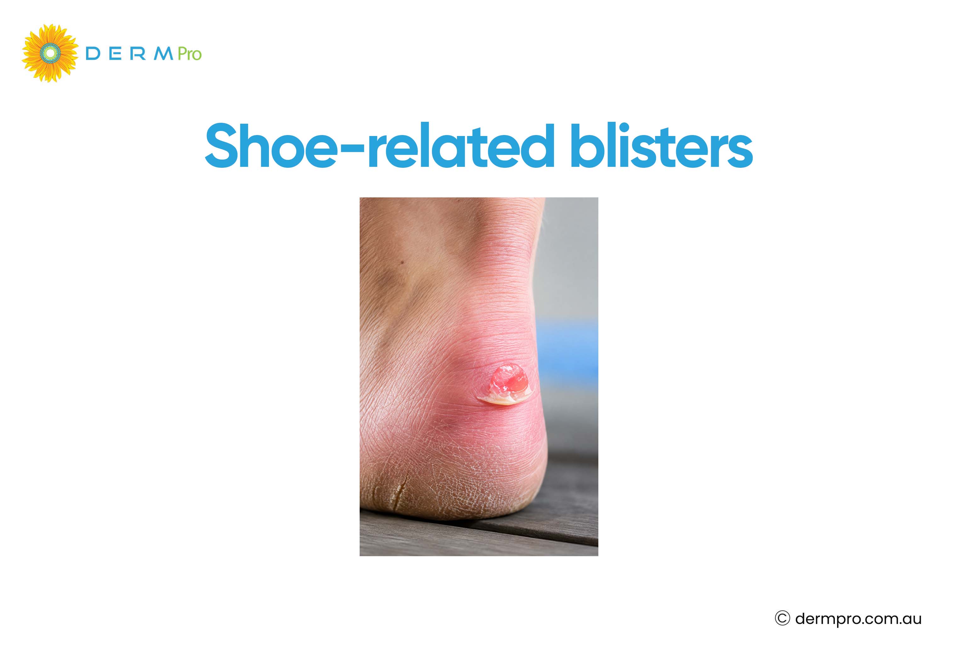 shoe related blisters 