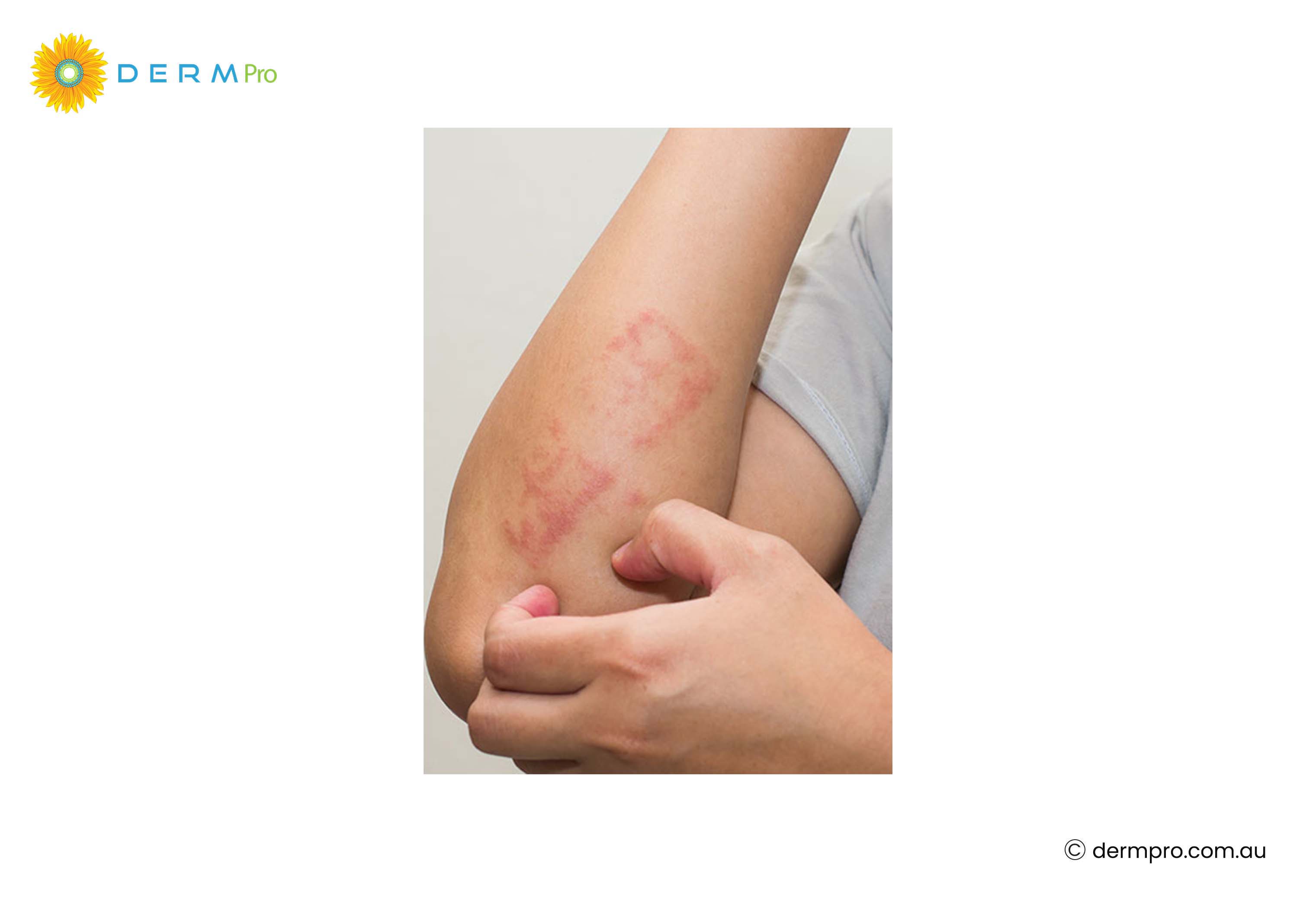 Eczema 