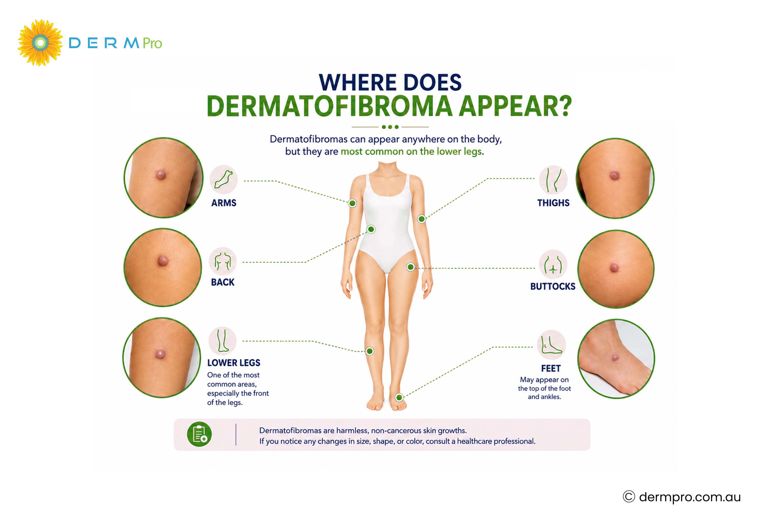 where does dermatofibroma appear