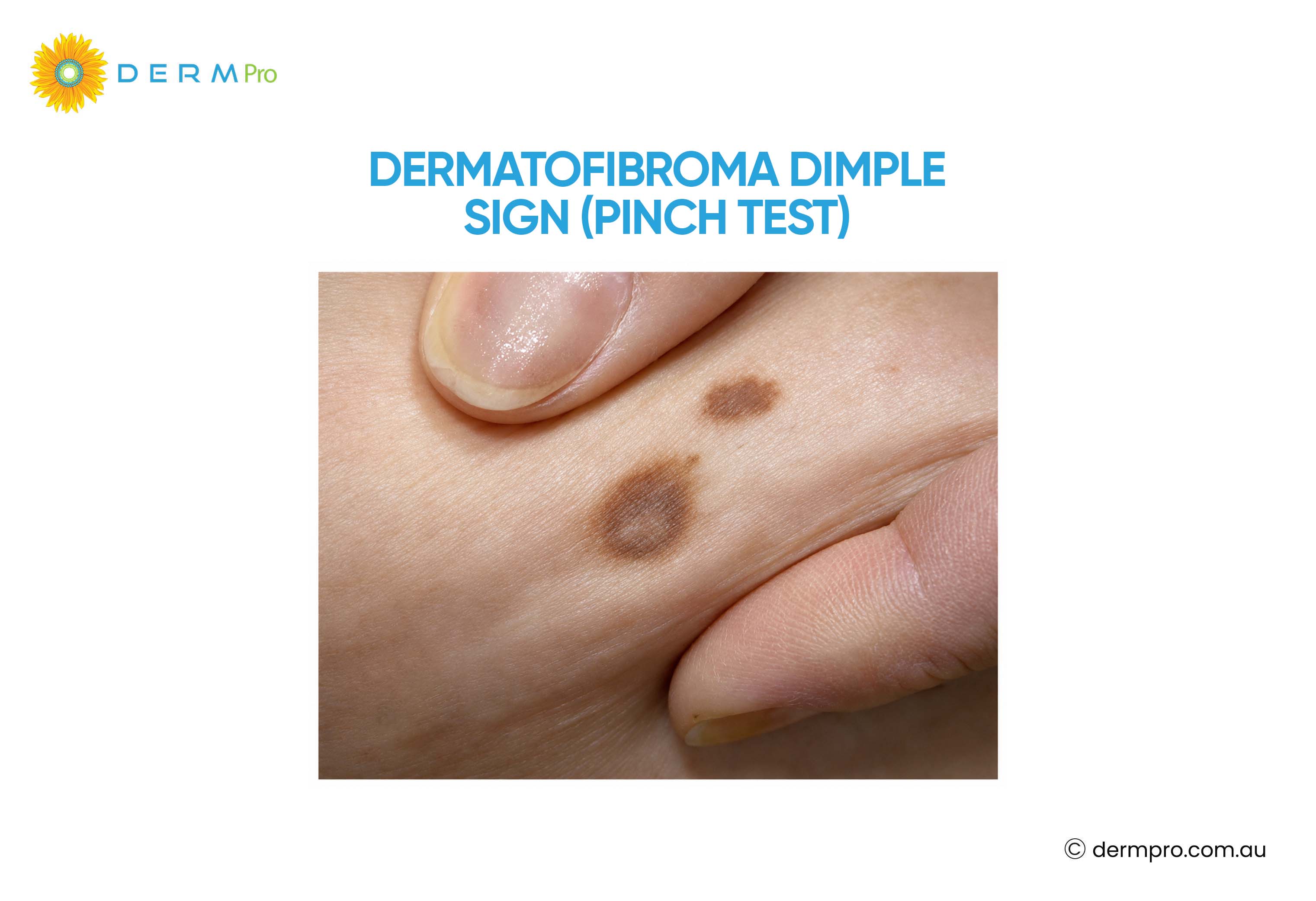dermatofibroma dimple sign (pinch test)