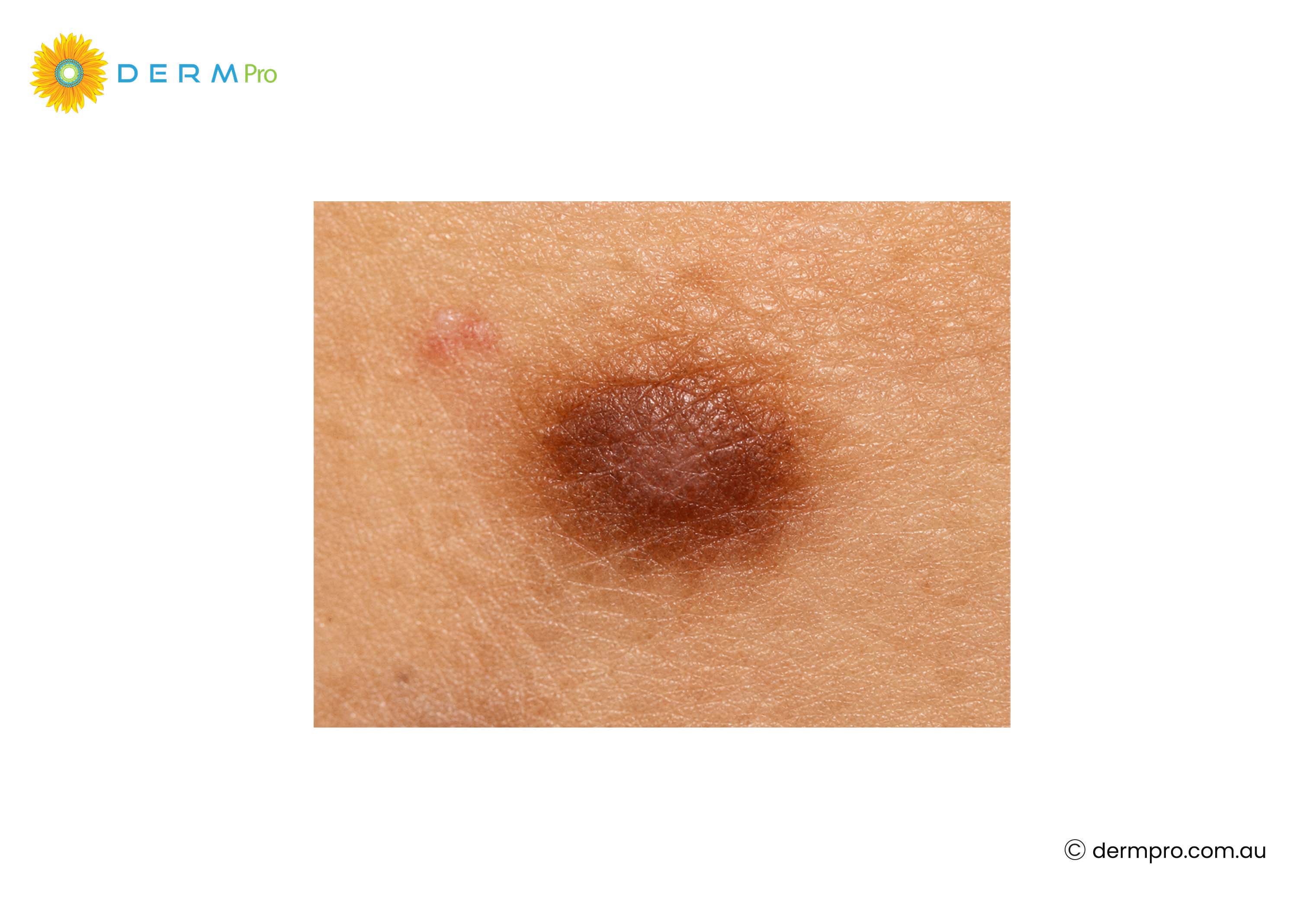 Dermatofibroma Images