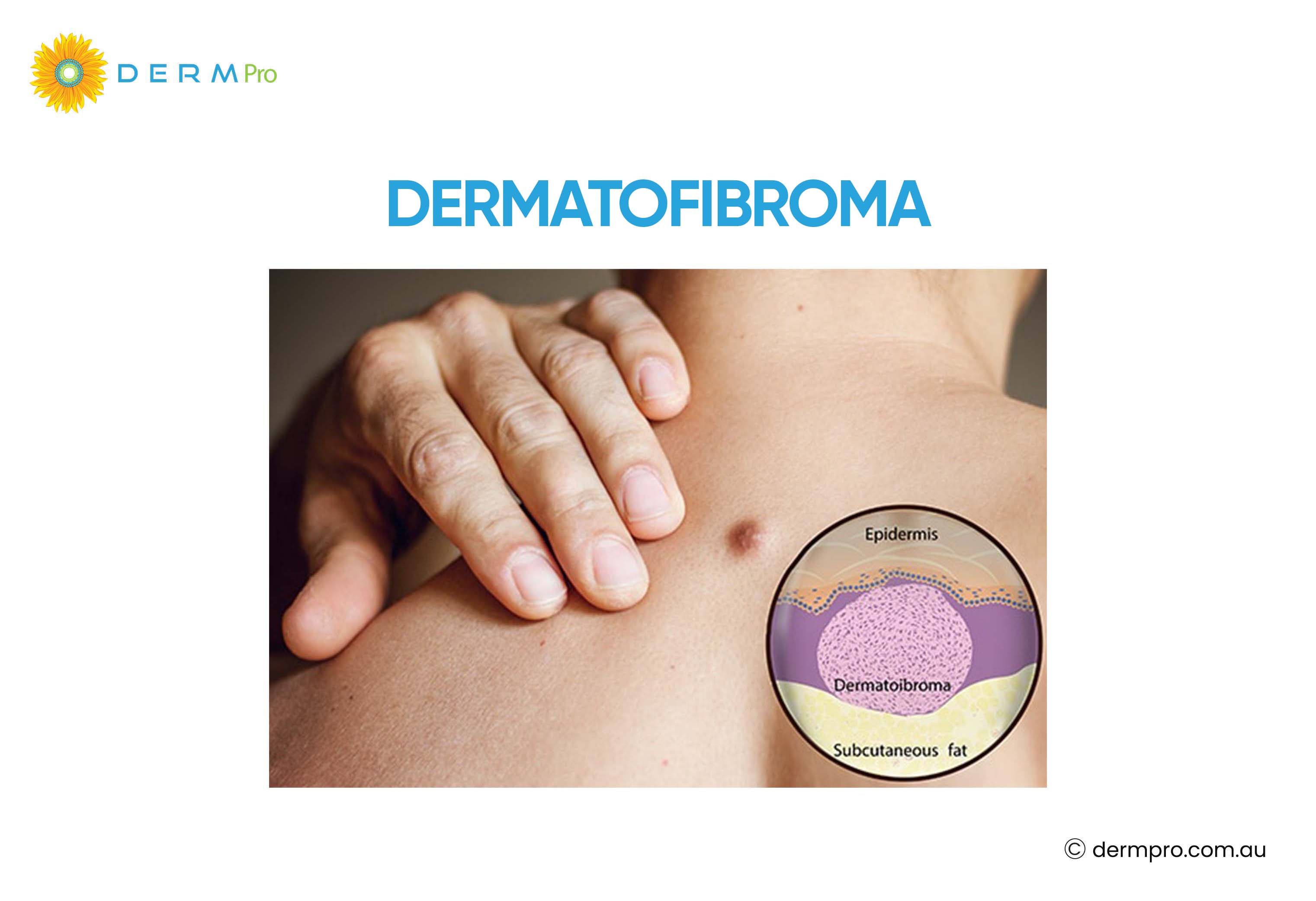 Dermatofibroma Images