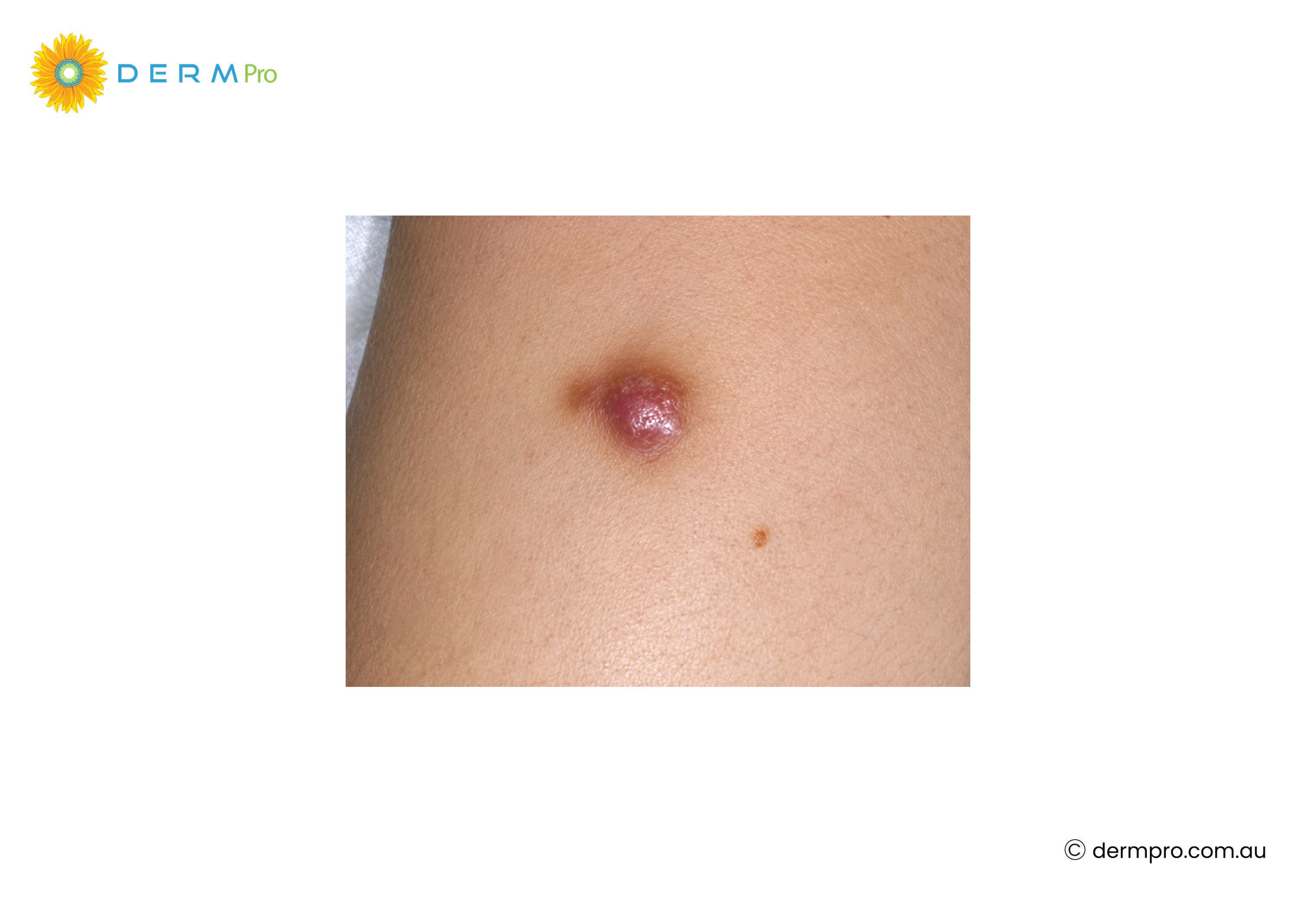 Dermatofibroma Images