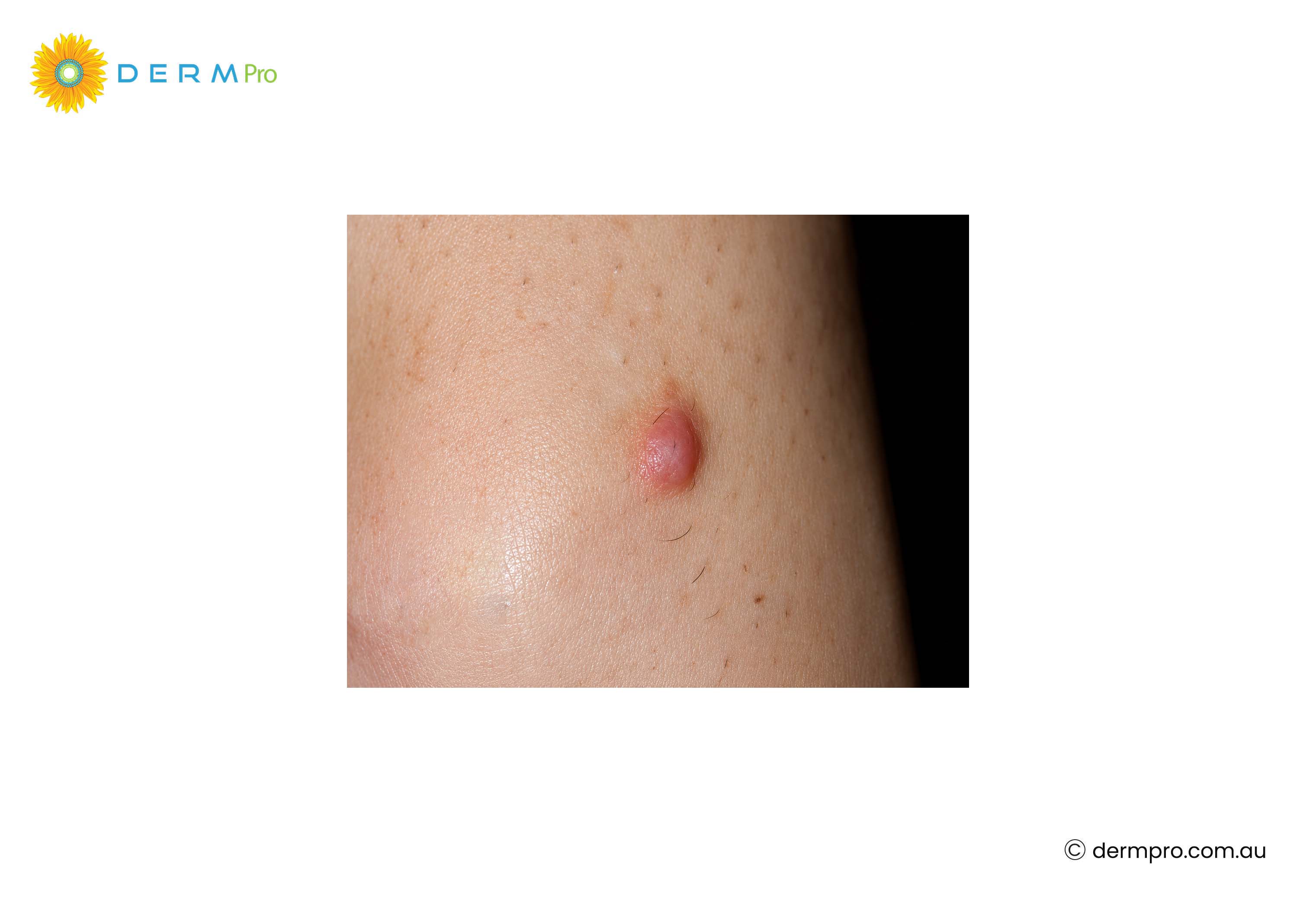Dermatofibroma Images