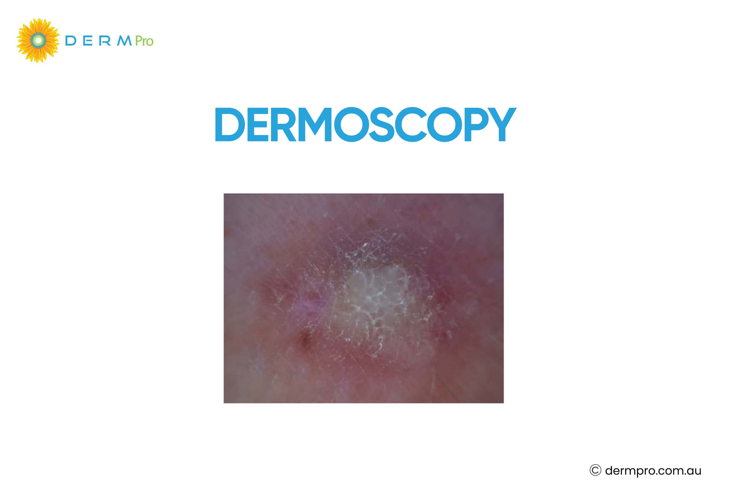 Dermoscopy image of dermatofibroma