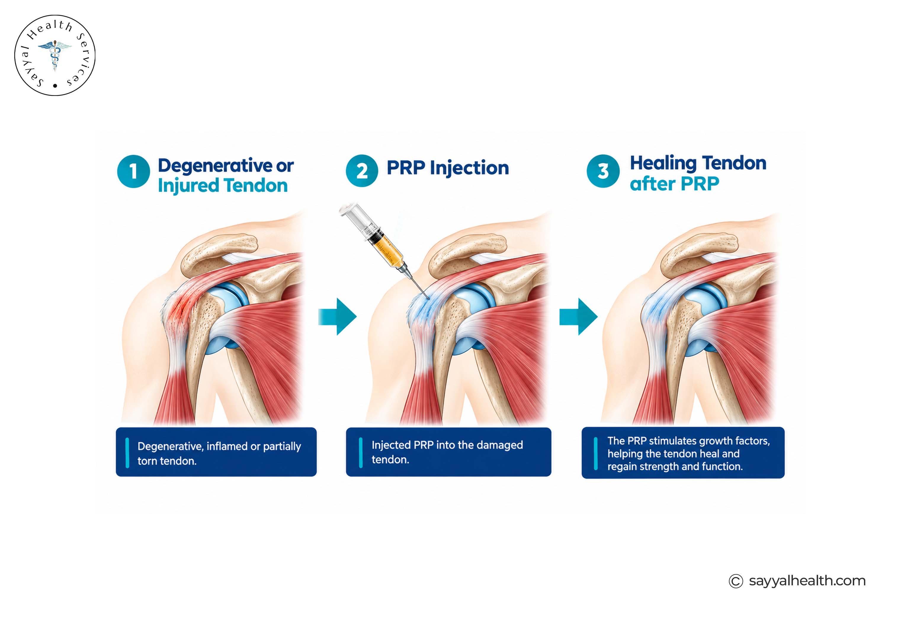 prp therapy for tendon injuries