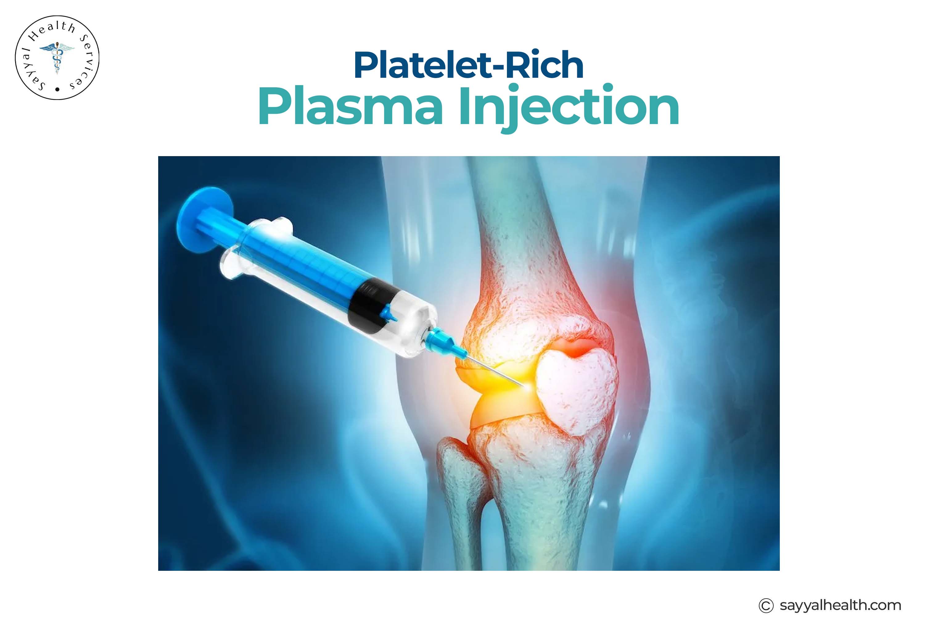 This image is about the visual representation of PRP injection.