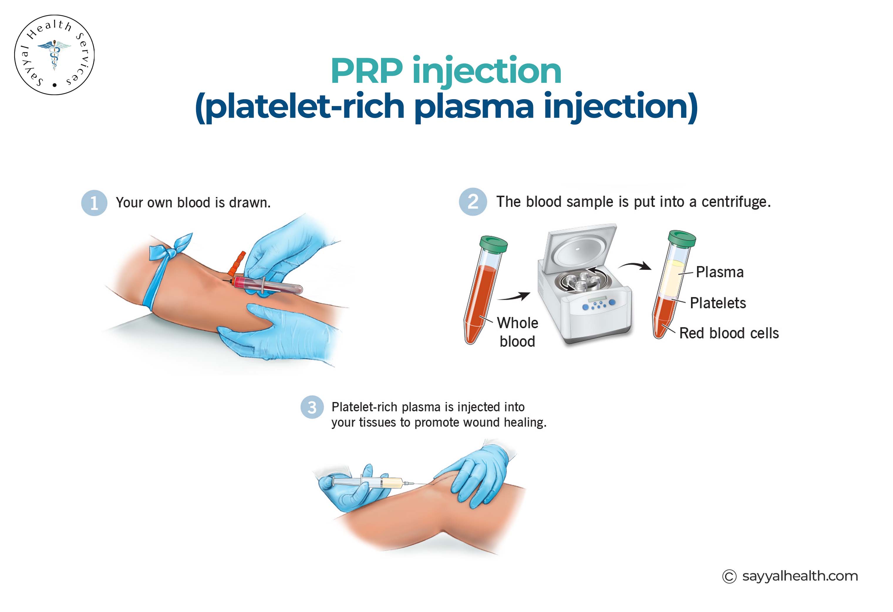 Platelet-Rich Plasma Injection Procedure