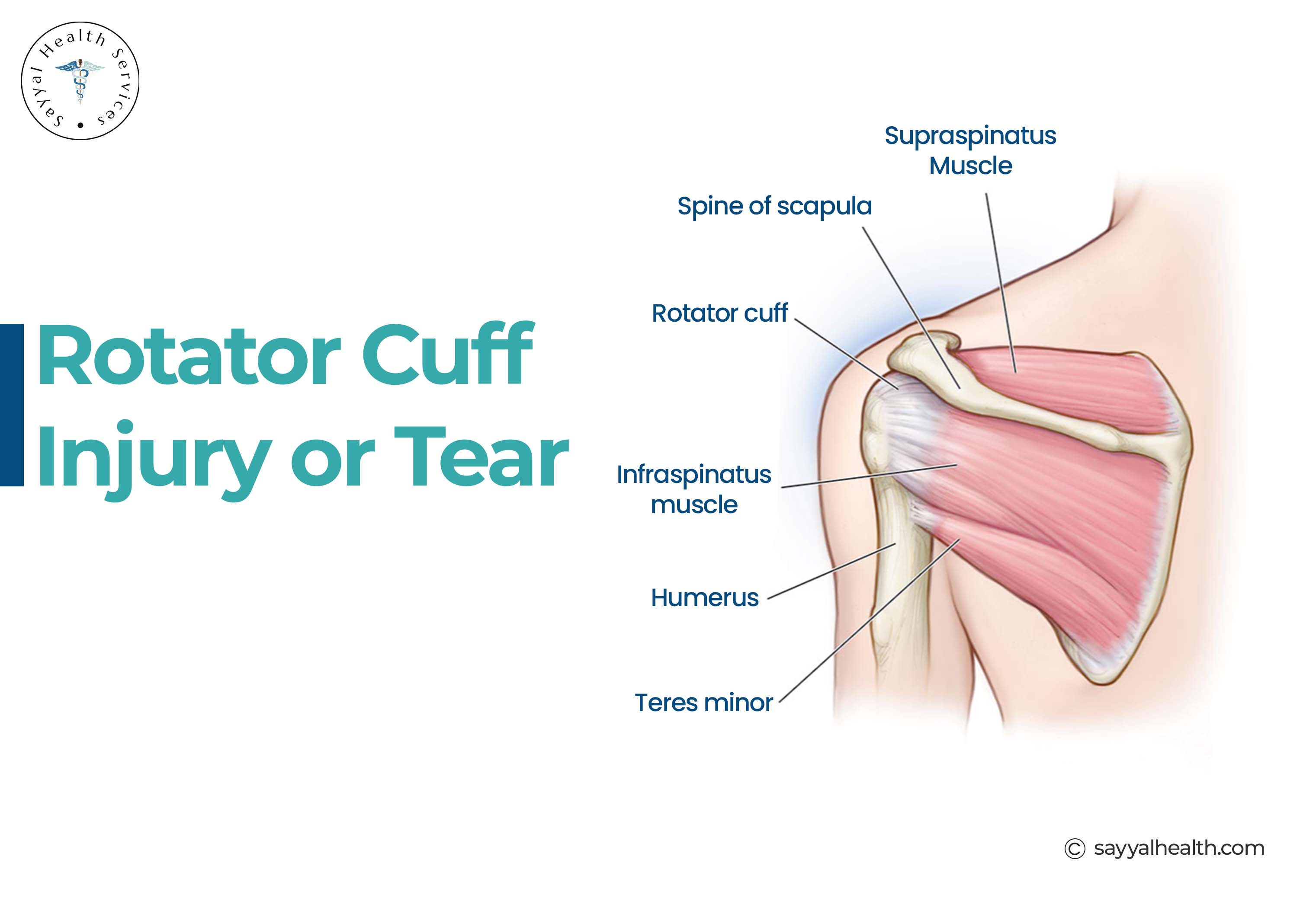 rotator cuff injury or tear