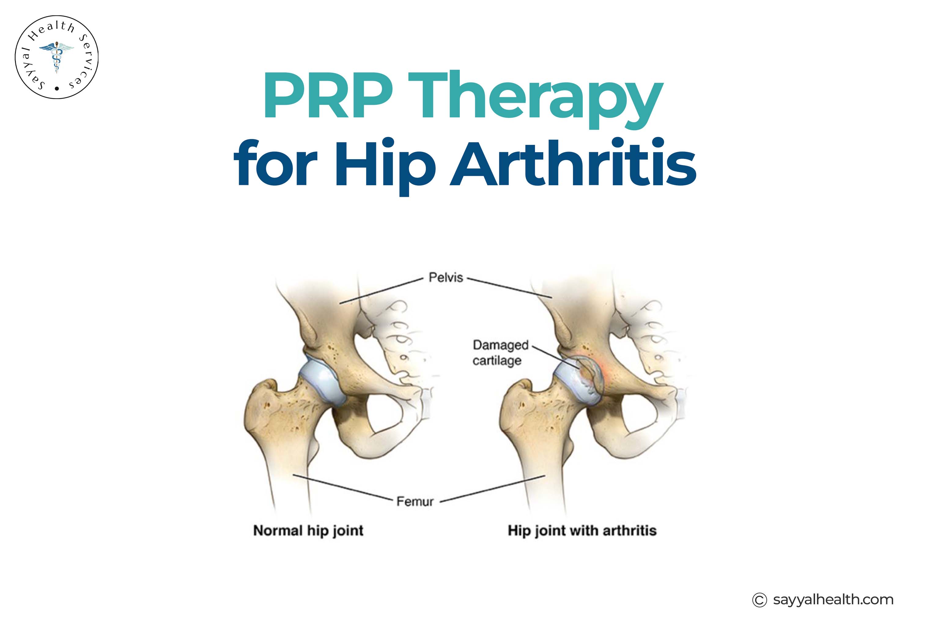Prp therapy for hip arthritis.